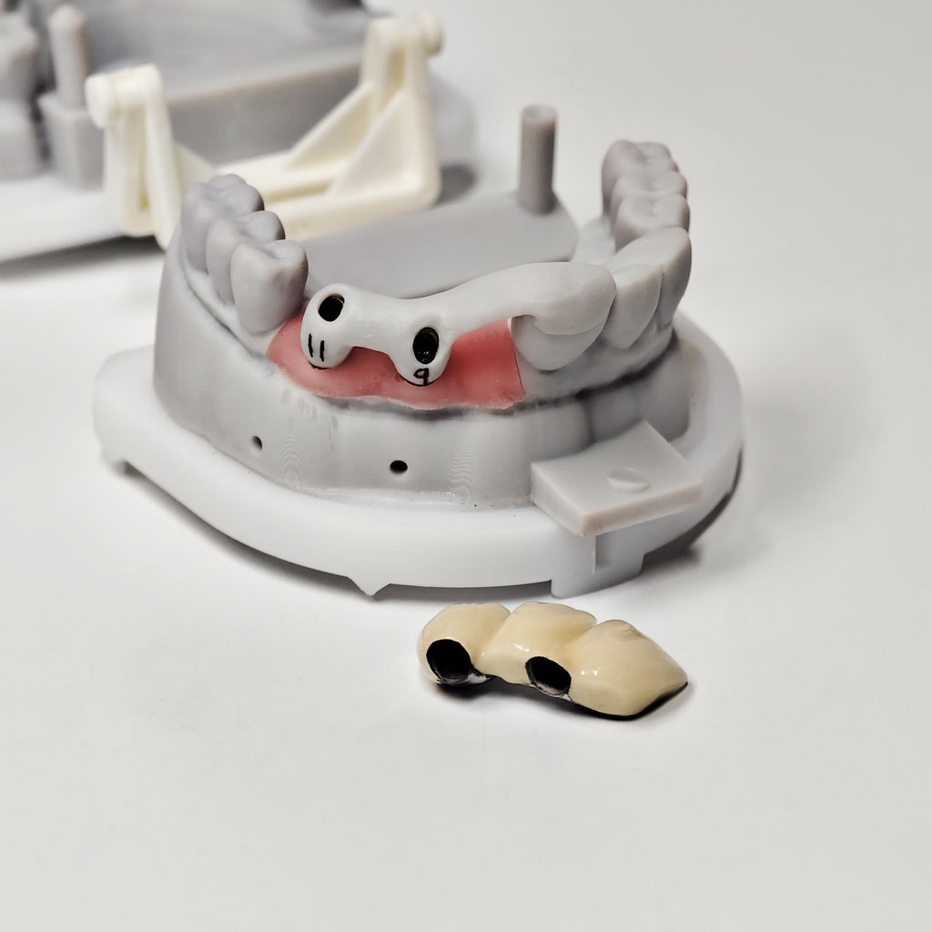 PFM Bridge With Screw-Retained And Implant Seating Guide