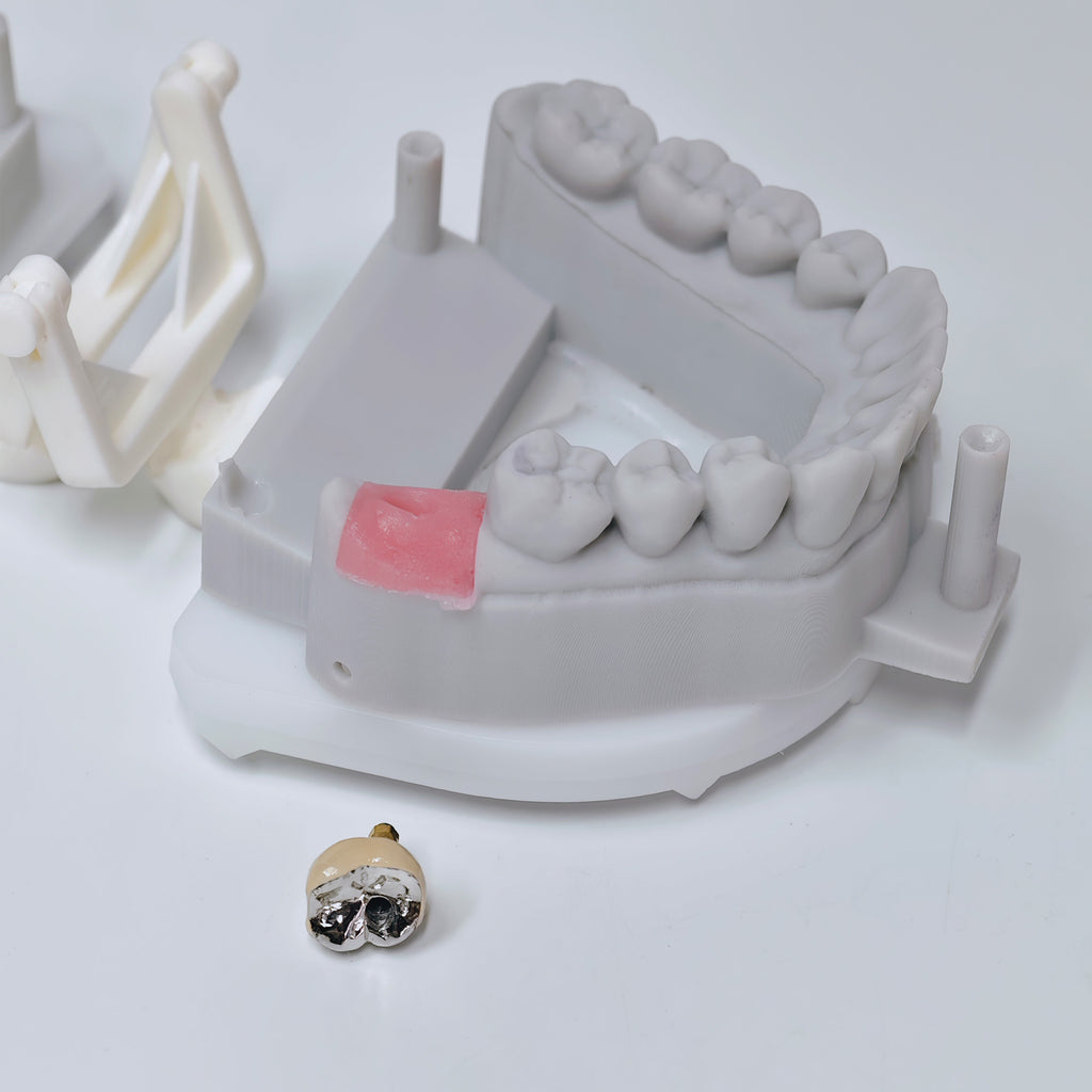 PFM Crown With Screw Retained