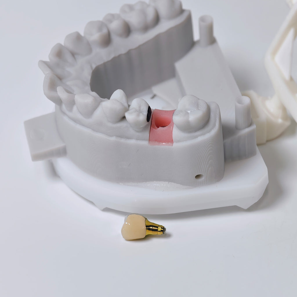 PFM Crown With Screw Retained
