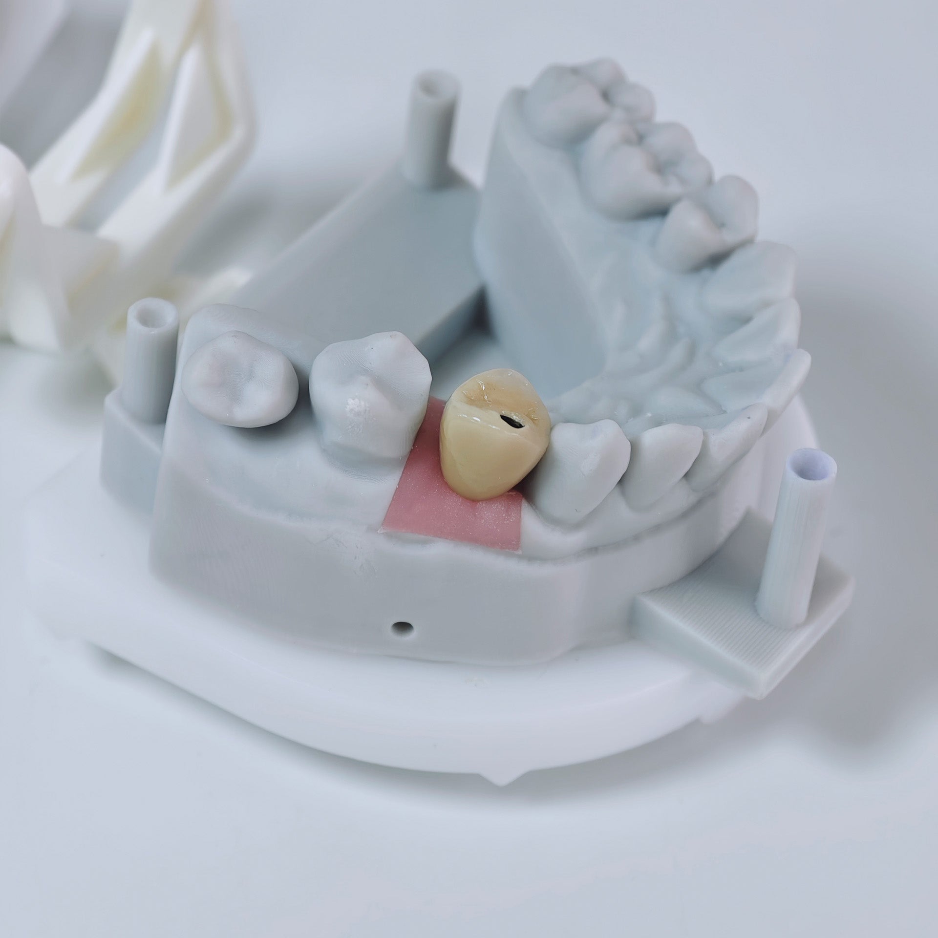 PFM Crown With Screw Retained