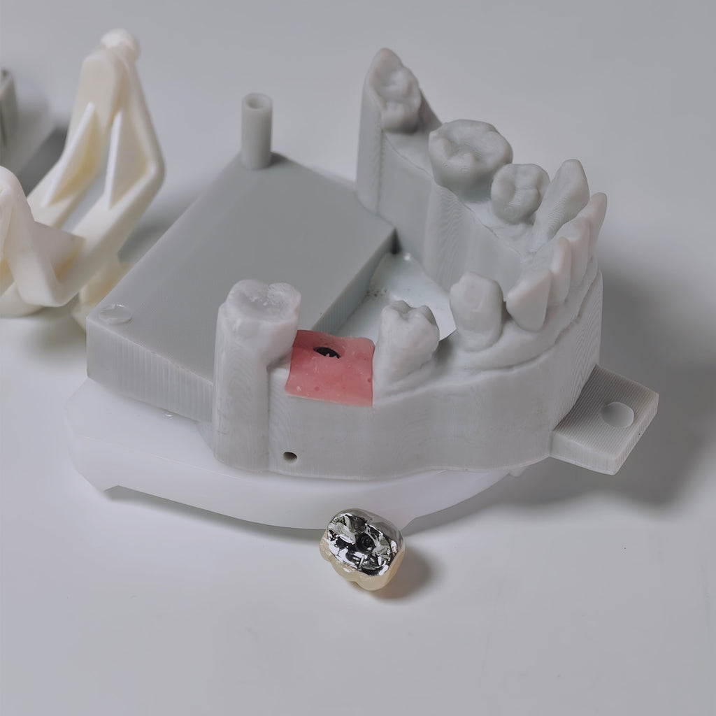 PFM Crown With Screw Retained