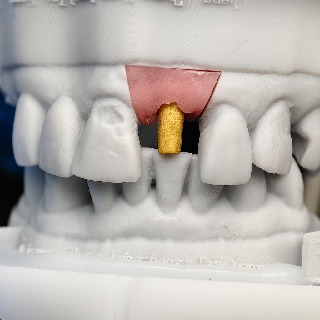 PFM Implant Crown With Cement Retained