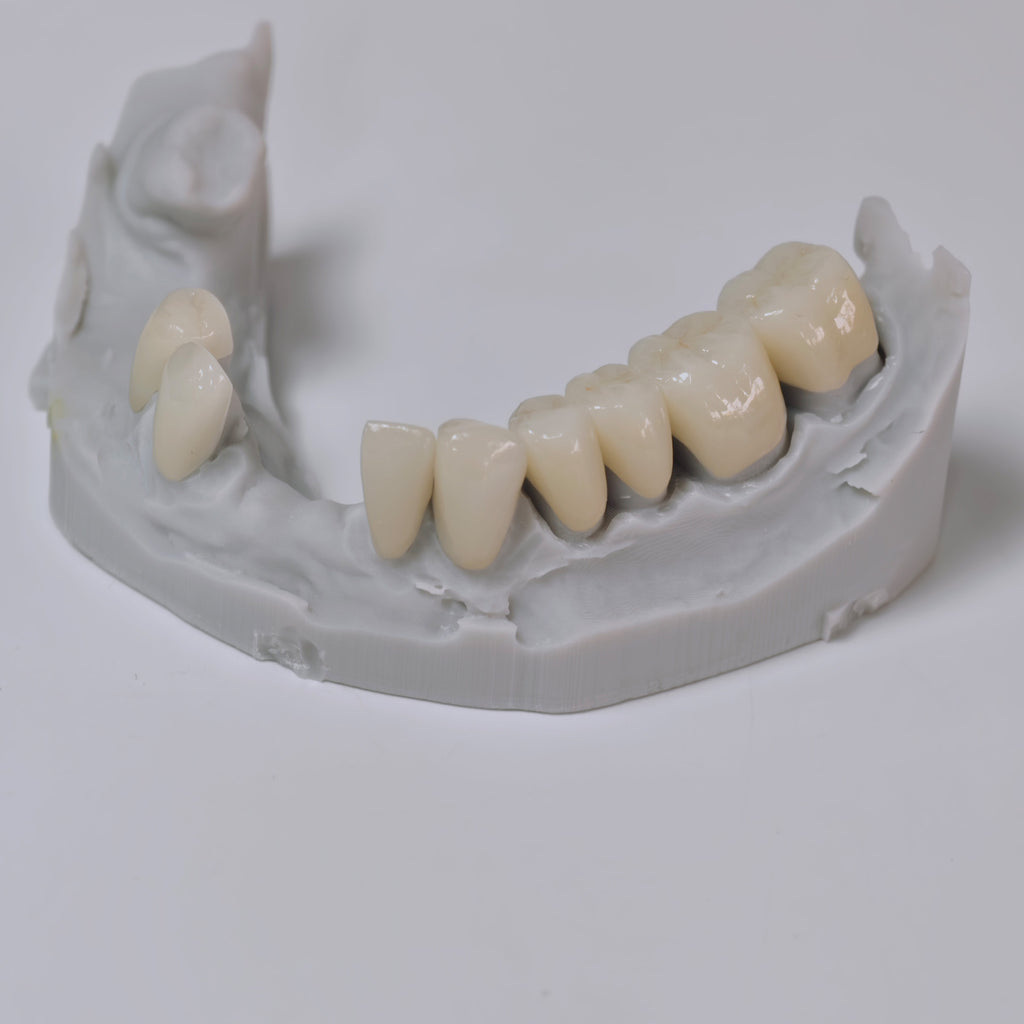 PFZ Porcelain Fused Zirconia Aidite Zirconia