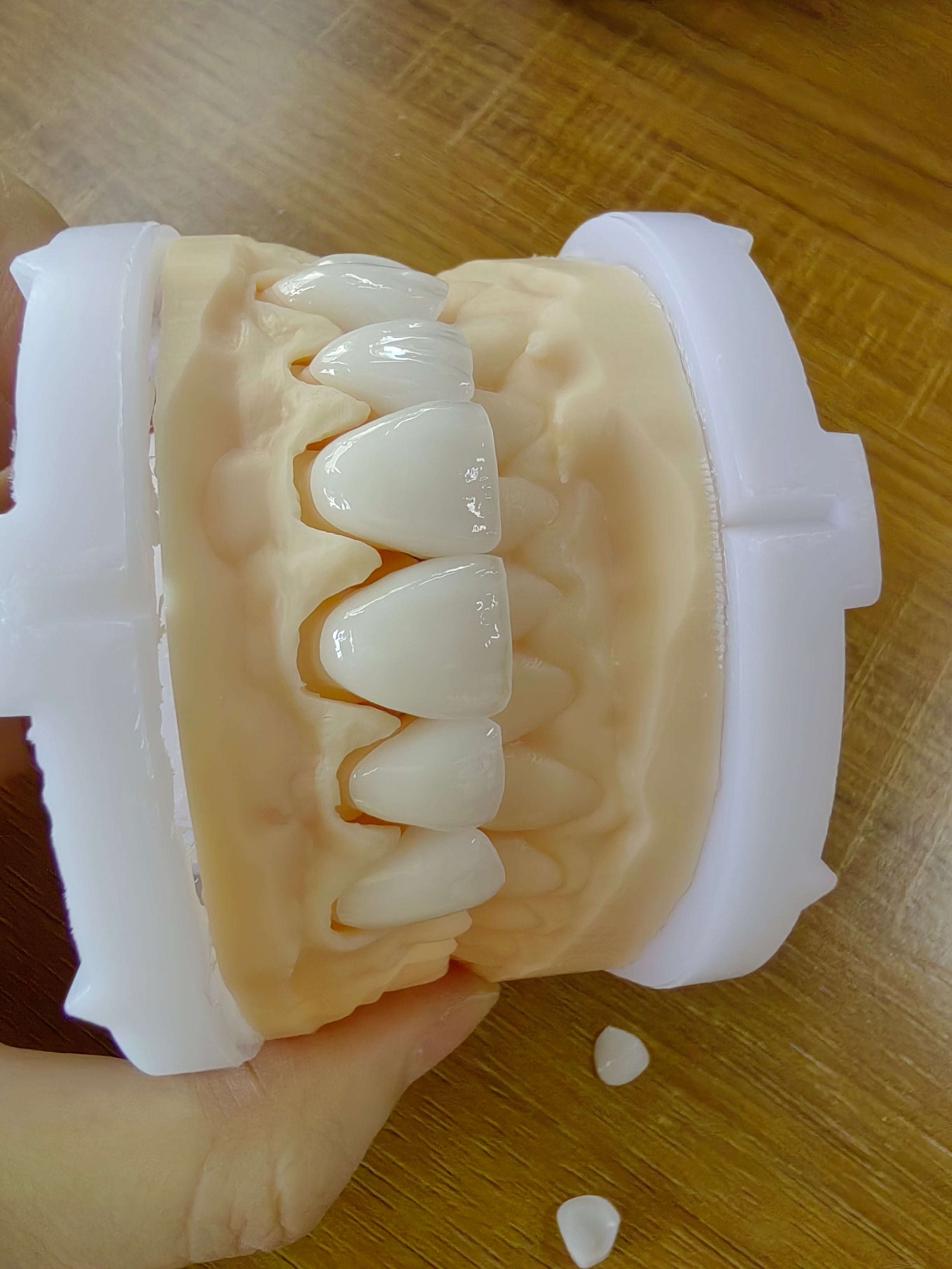PFZ Zirconia Crowns And Bridge