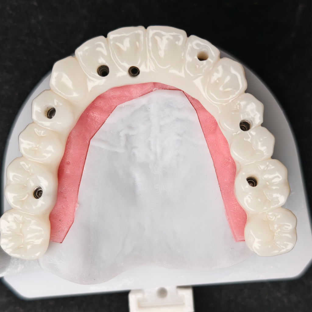 PMMA Bridge With Ti-Base Screw Retained Trying For Full Arch Restoration