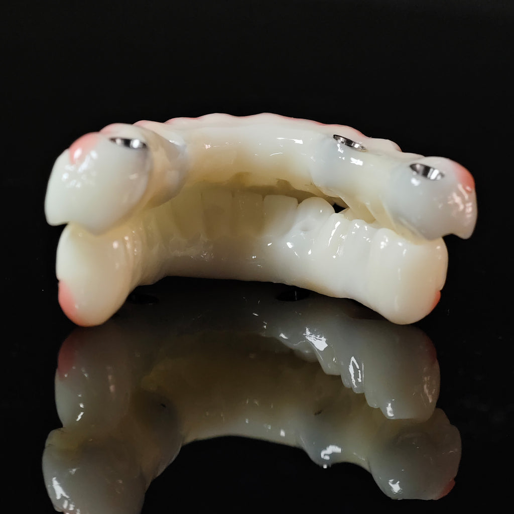 PMMA Bridge With Ti-Base Screw Retained Trying For Full Arch Restoration