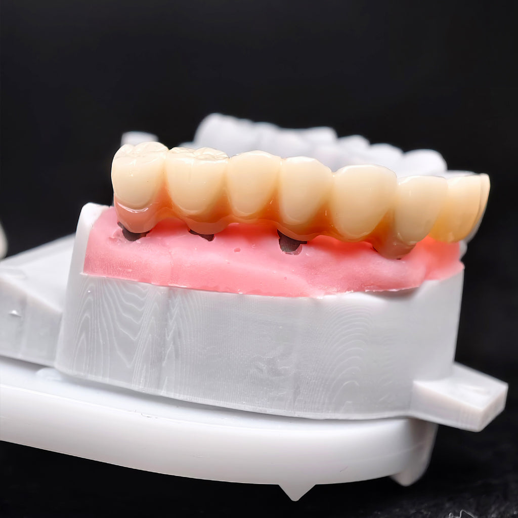 PMMA Bridge With Custom Abutment And Implant Seating Guide