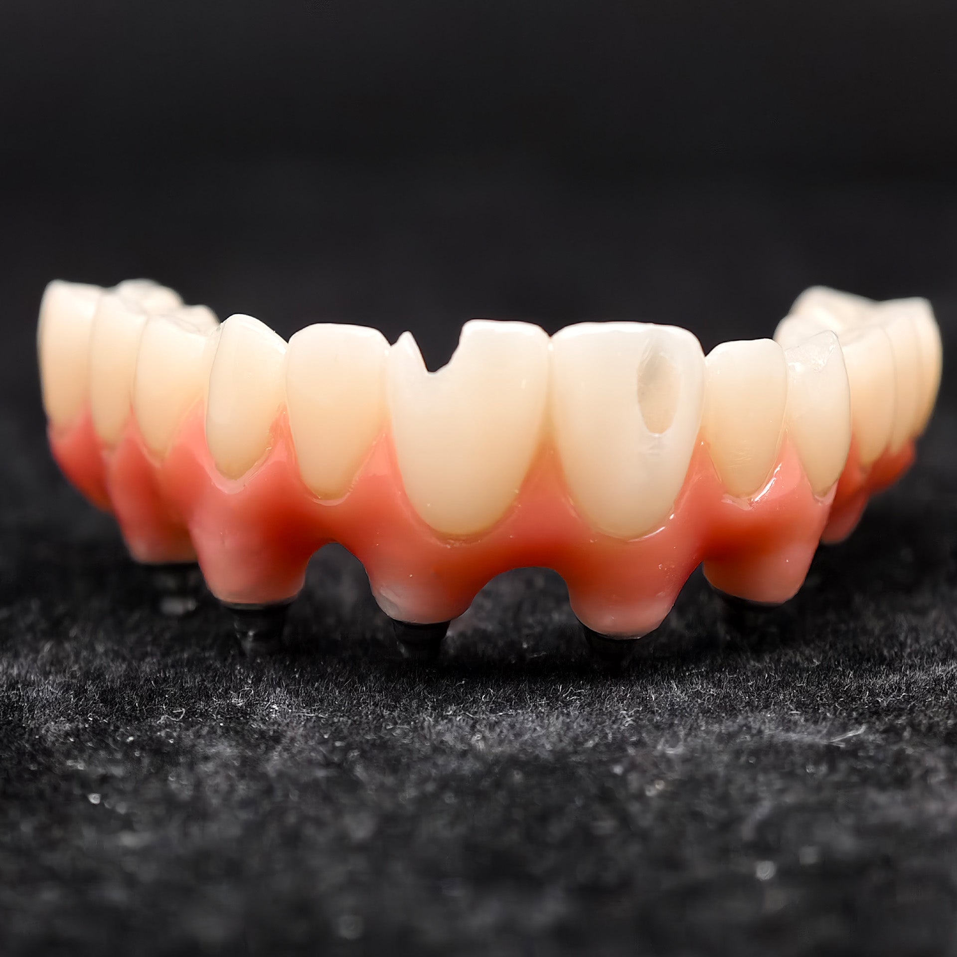 Pmma Bridge With Screw-Retained