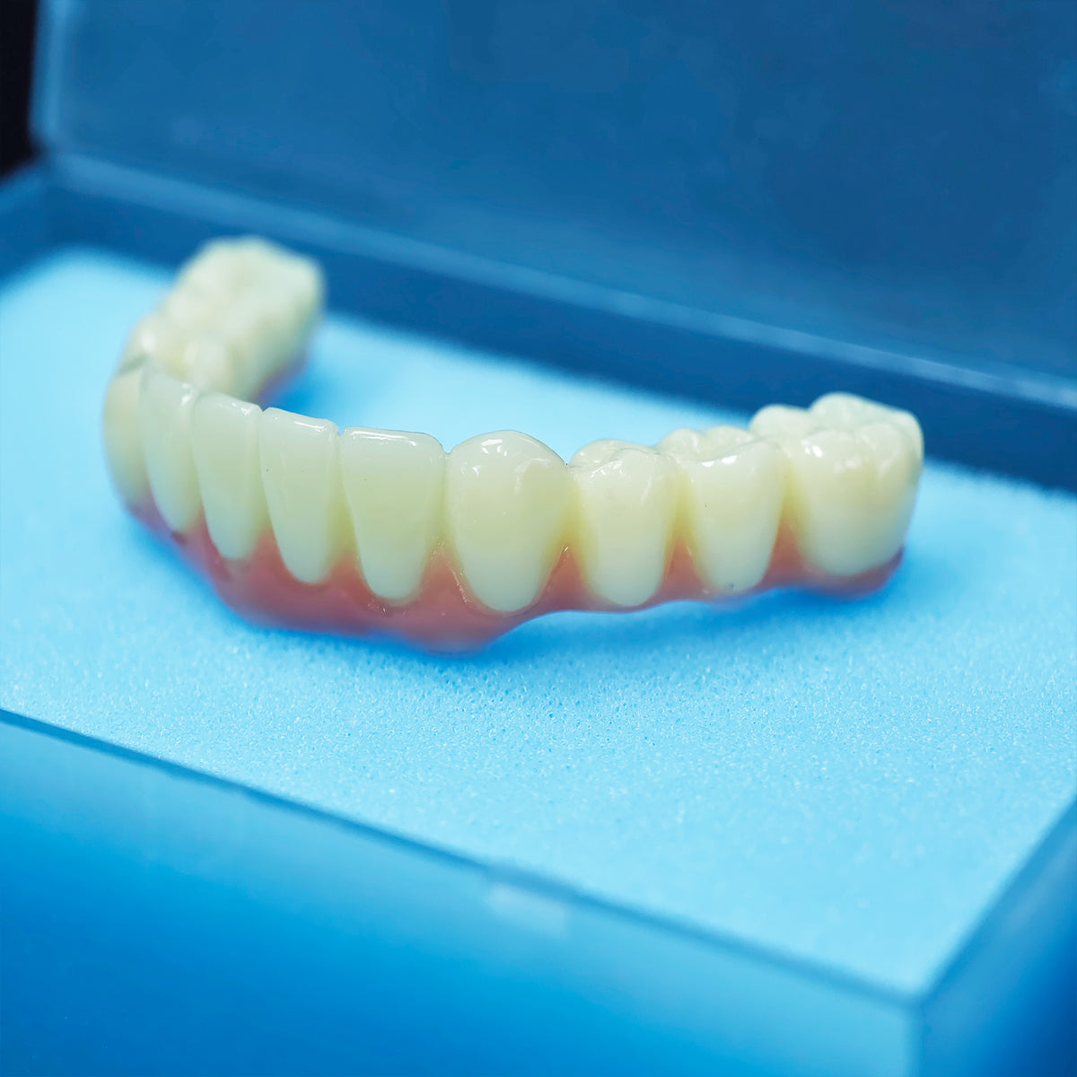 PMMA Bridge With Screw Retained