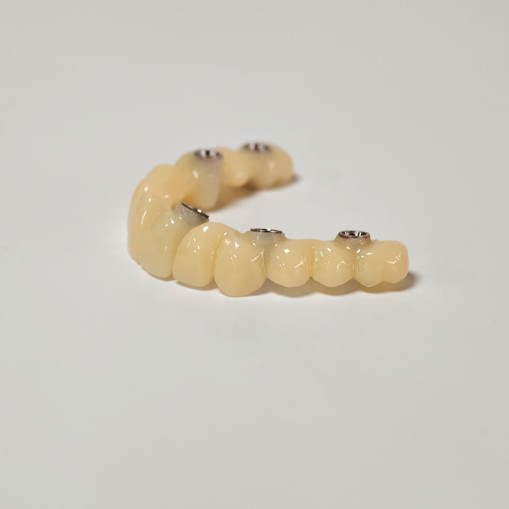 PMMA Bridge With Screw Retained