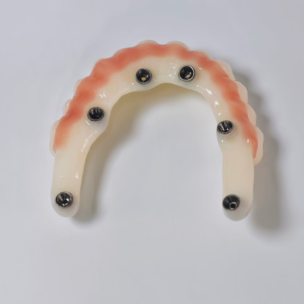 PMMA Bridge With Screw Retained