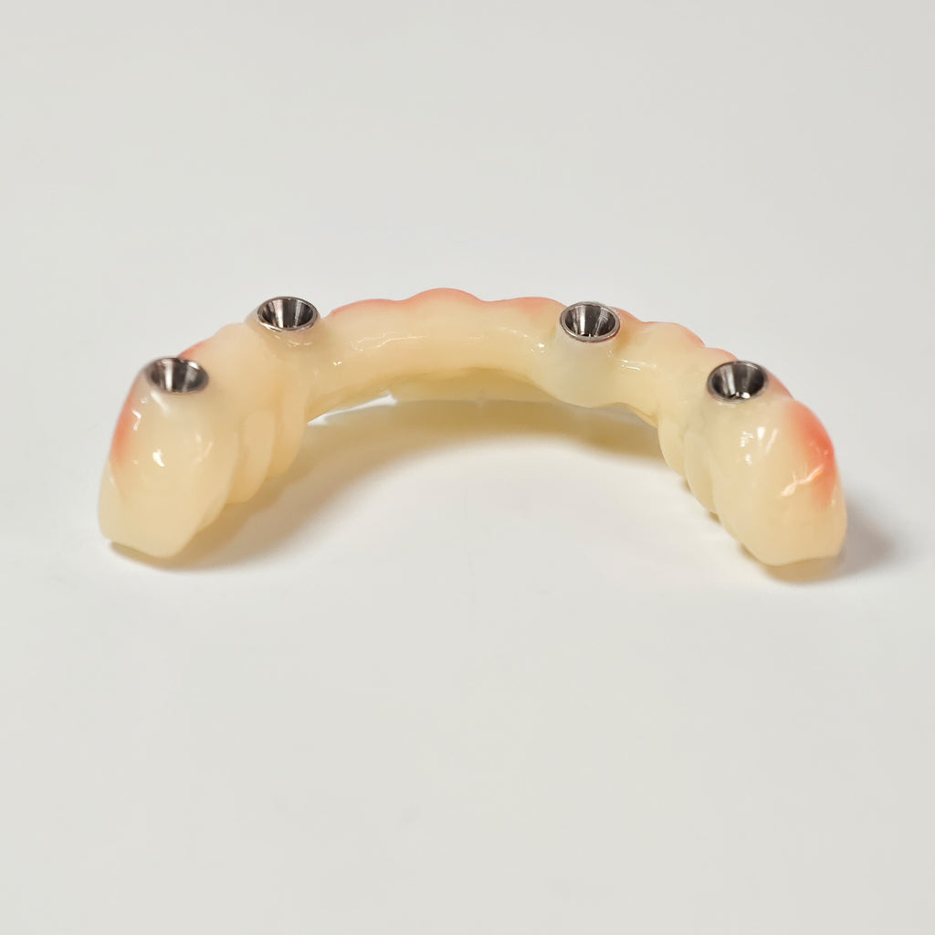 PMMA Bridge With Screw Retained