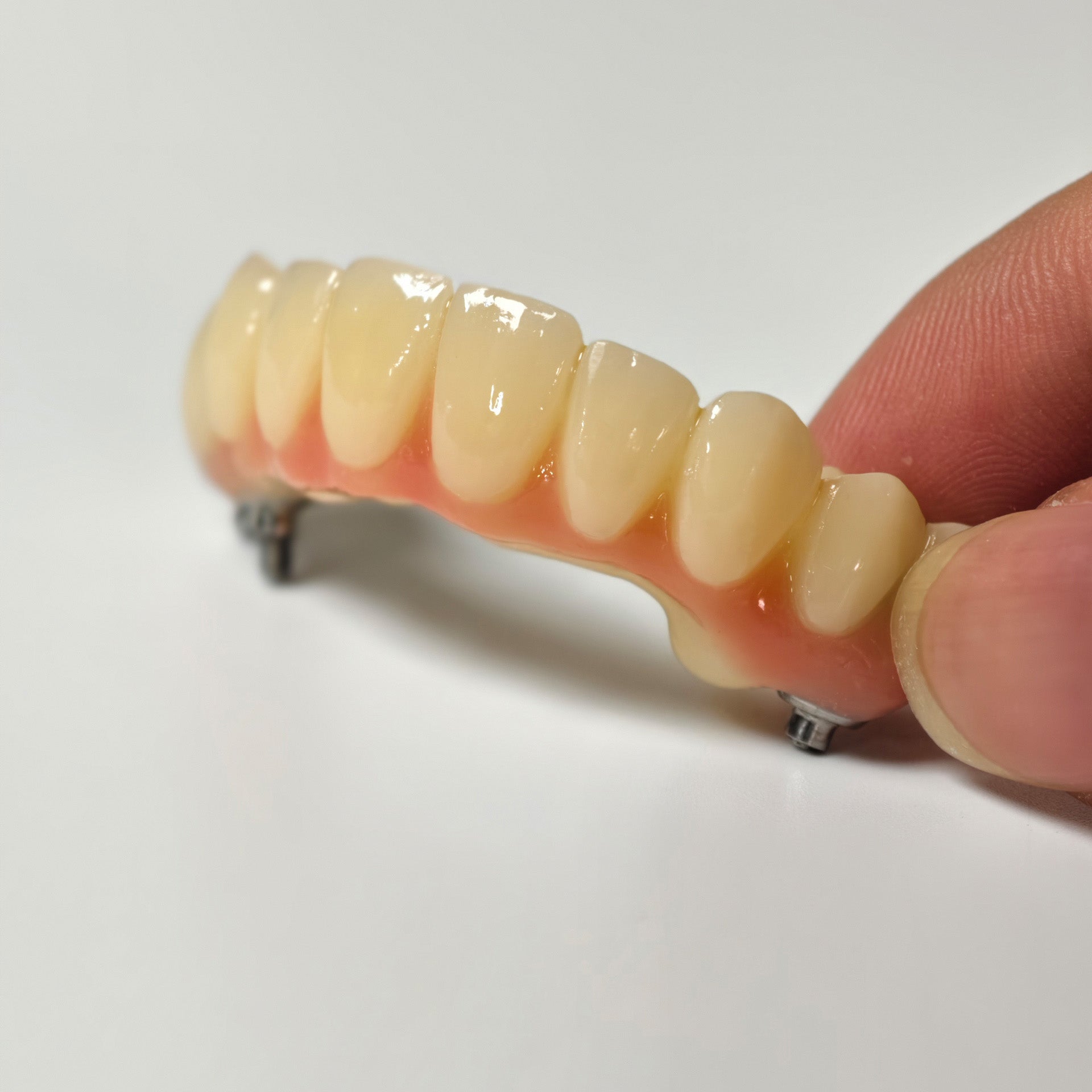 PMMA Bridge With Screw Retained