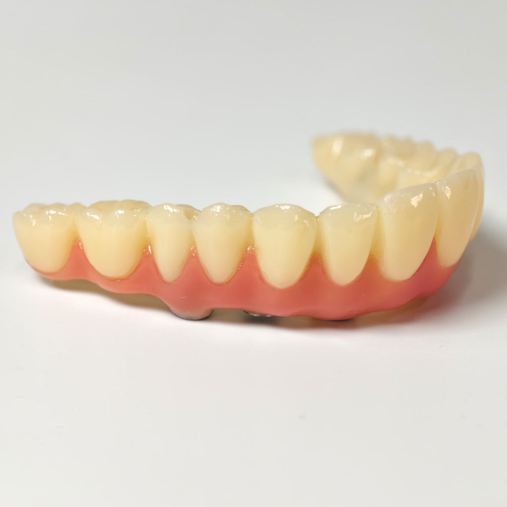 PMMA Bridge With Screw Retained