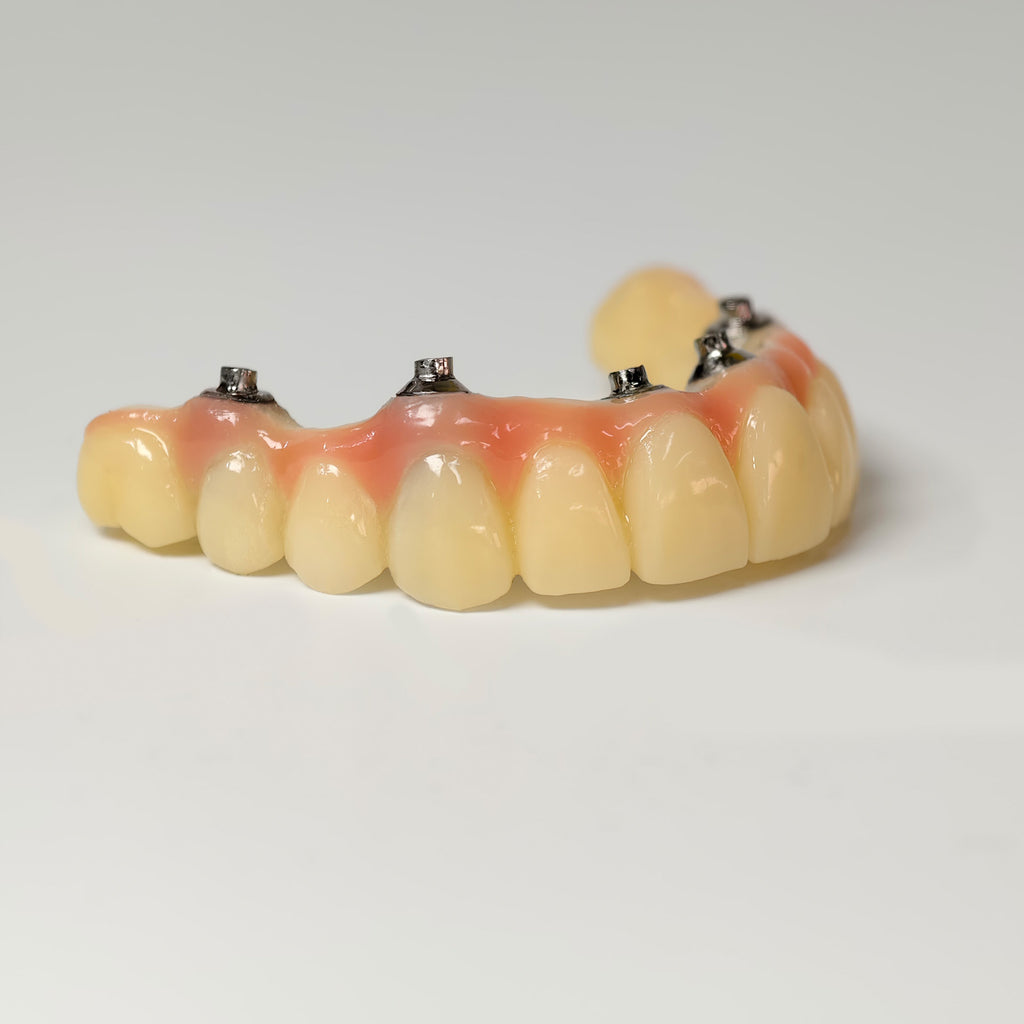 PMMA Bridge With Screw Retained