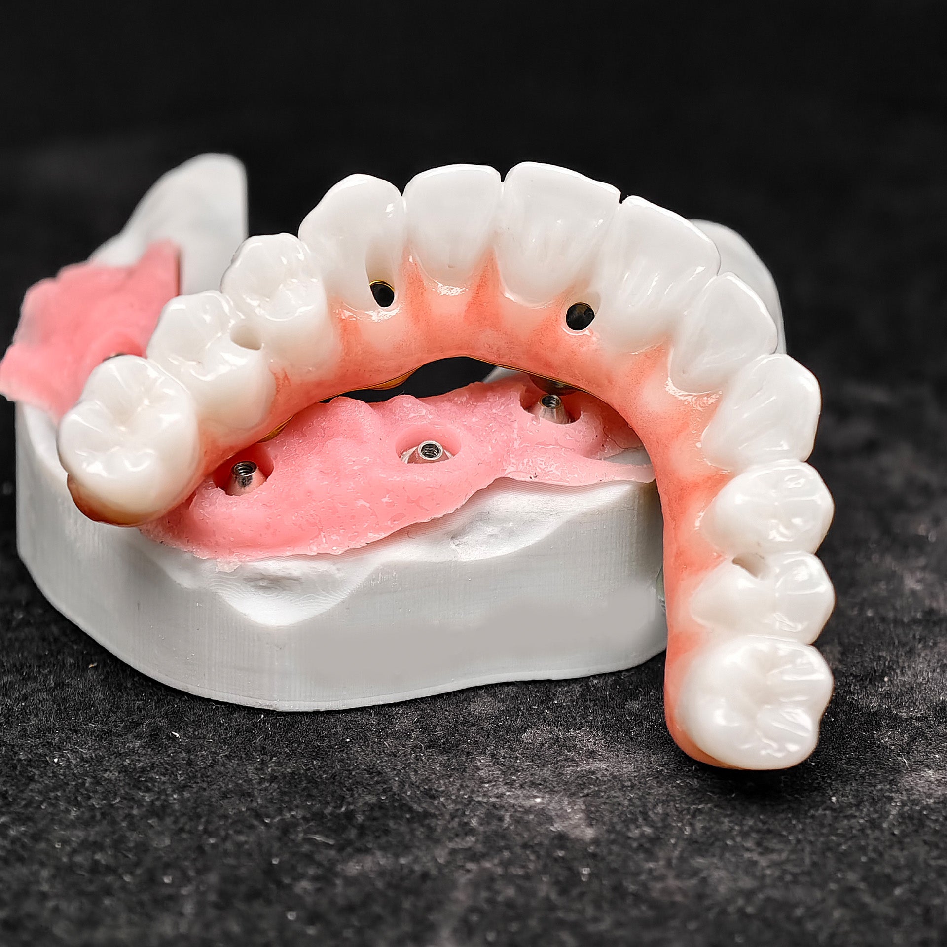 Ti-Bar Titanium Nitride Metal Frame With Zirconia Bridge For Full Arch Restoration