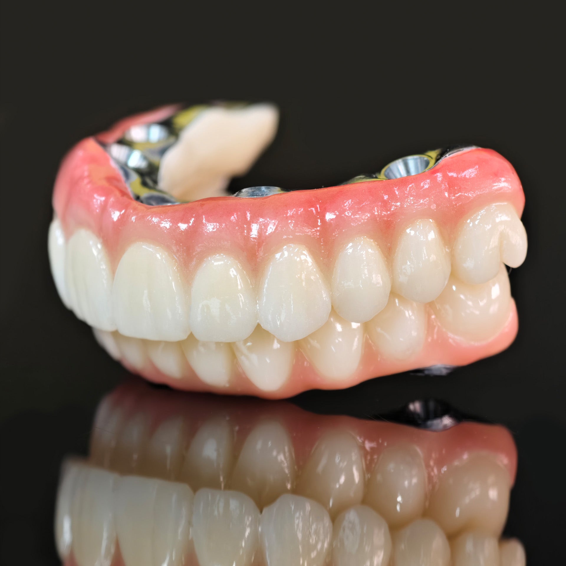 Ti-Bar Titanium Nitride Metal Frame With Zirconia Bridge For Full Arch Restoration