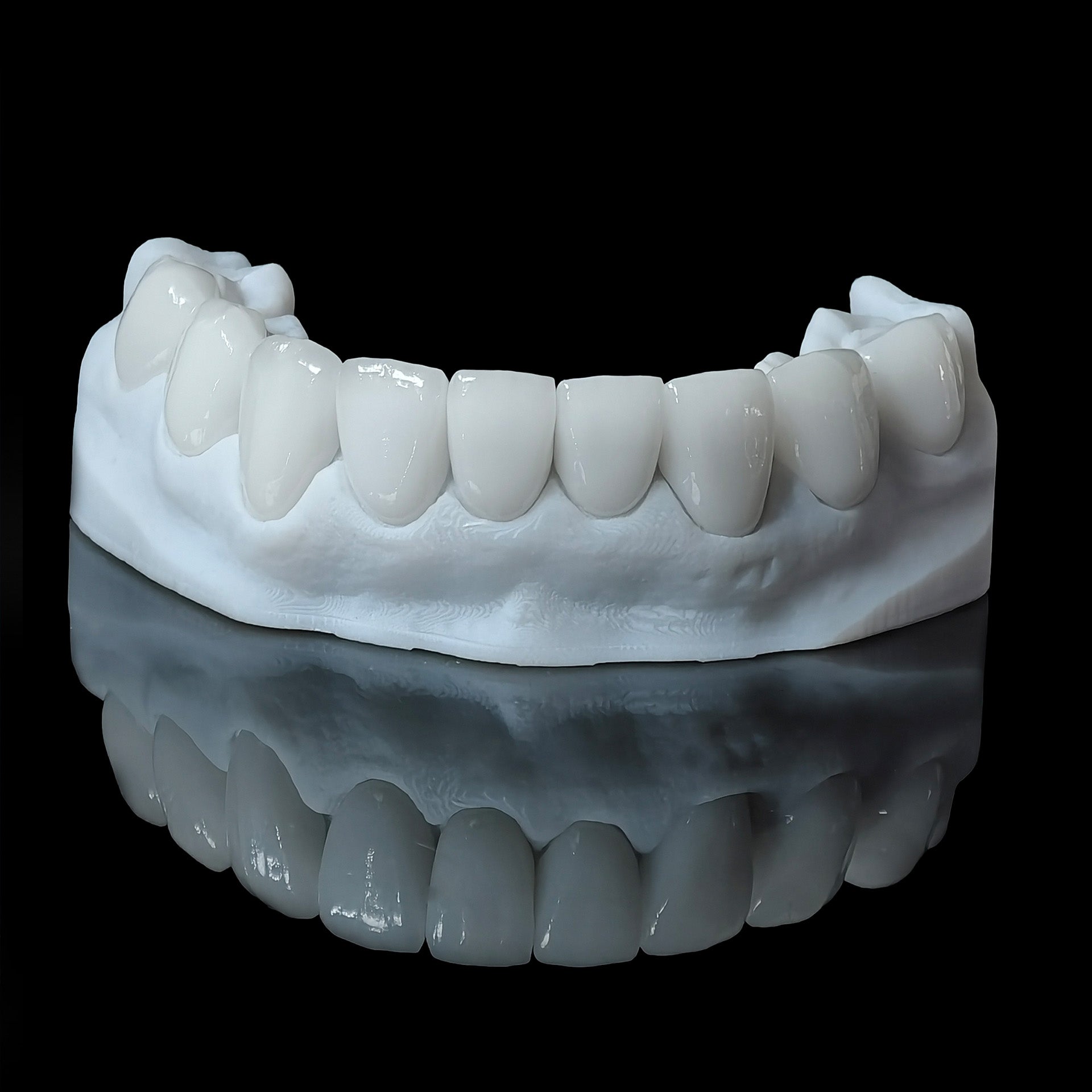 Ultra-Thin Emax Veneer. High Transparency/Translucent, Natural Shade