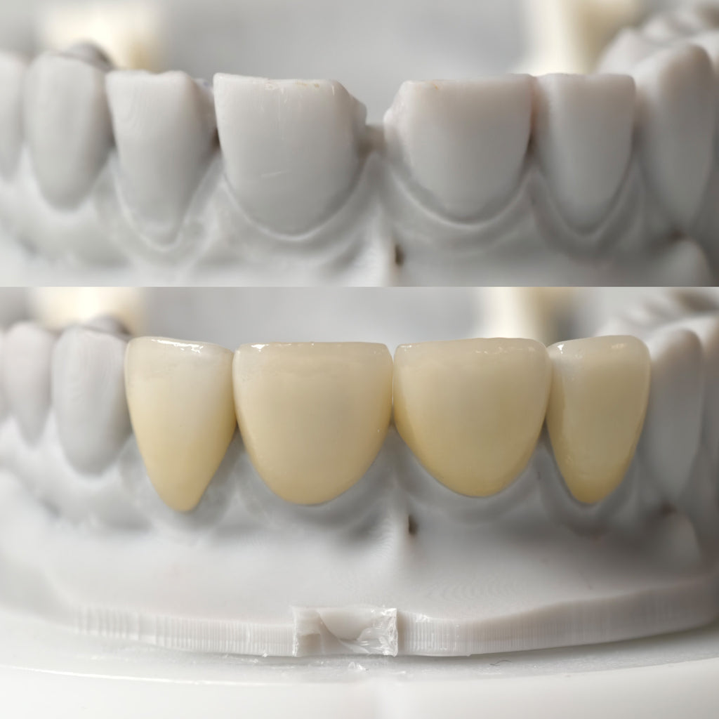 Ultra-Thin Emax Veneer. High Transparency/Translucent, Natural Shade