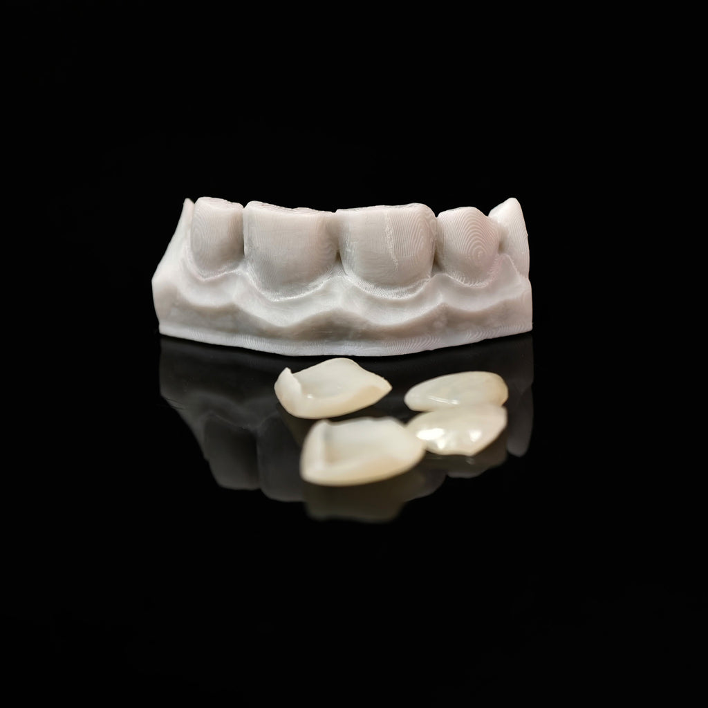 Ultra-Thin Emax Veneer. High Transparency/Translucent, Natural Shade