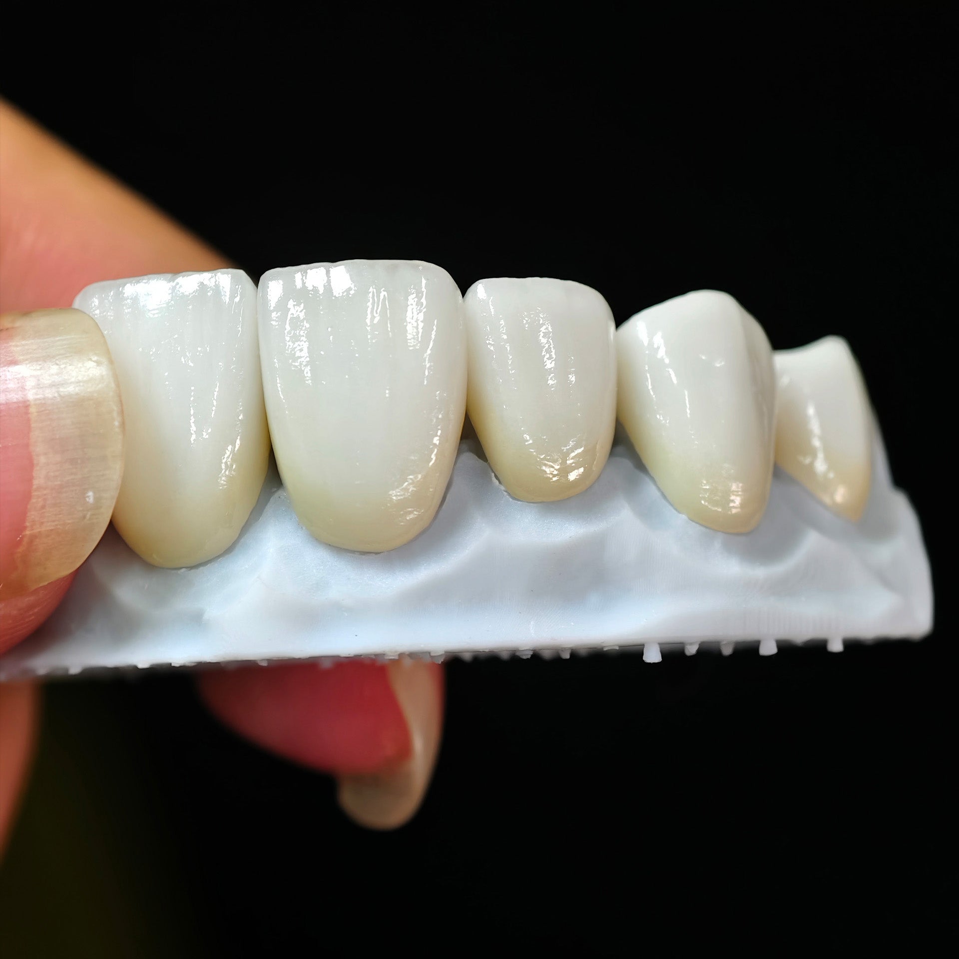 Ultra-Thin Emax Veneer. High Transparency/Translucent, Natural Shade
