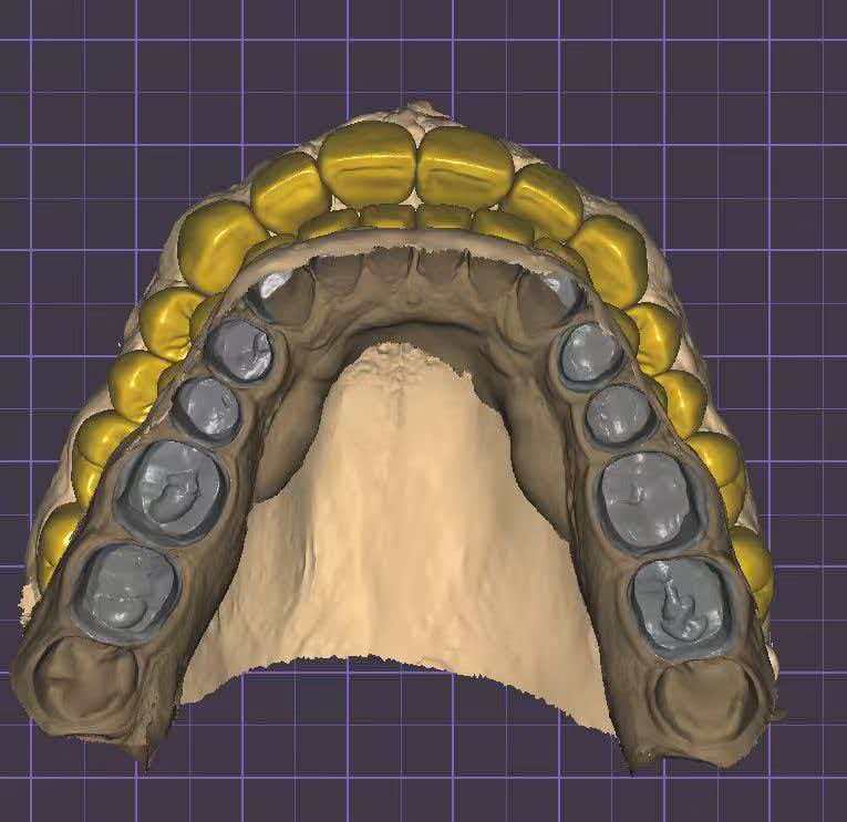 Upper And Lower Smile Design