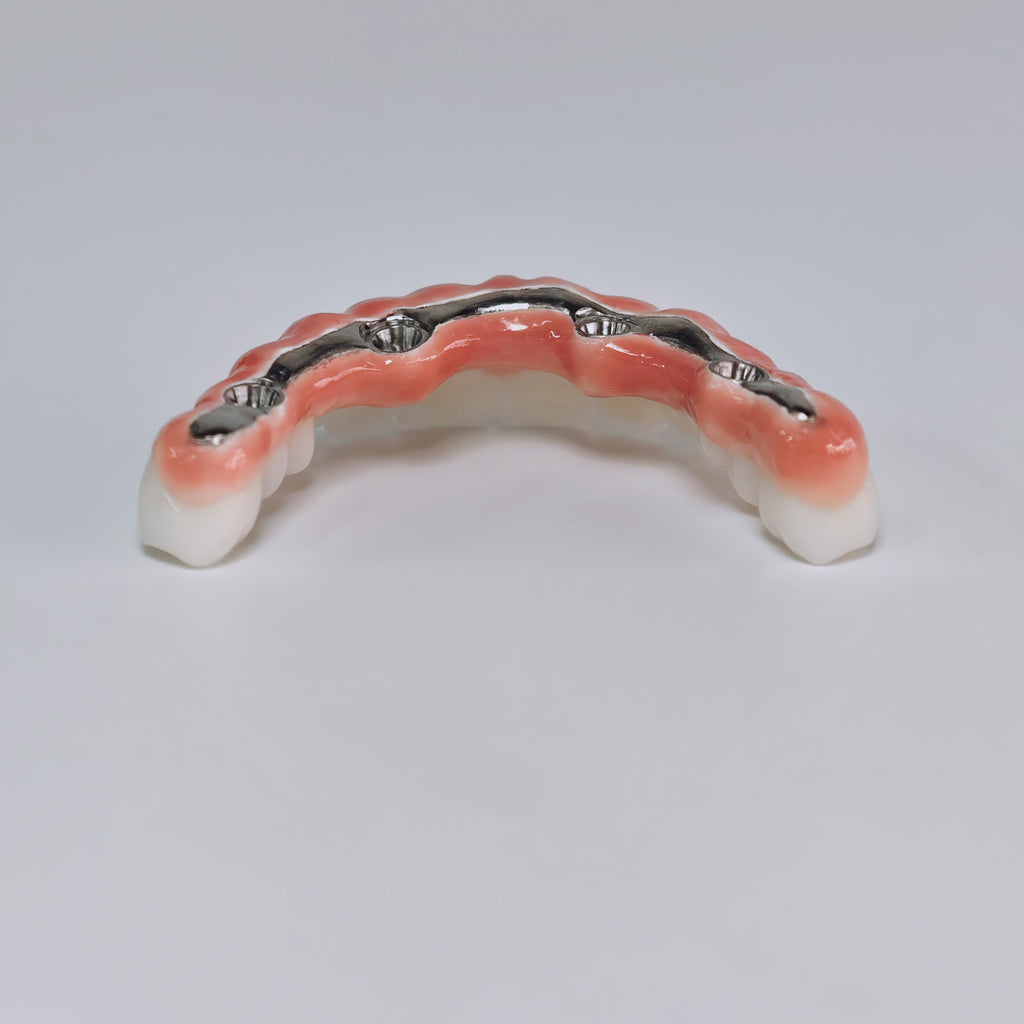 Zirconia-Enamel Hybrid Malo Bridge Aesthetic