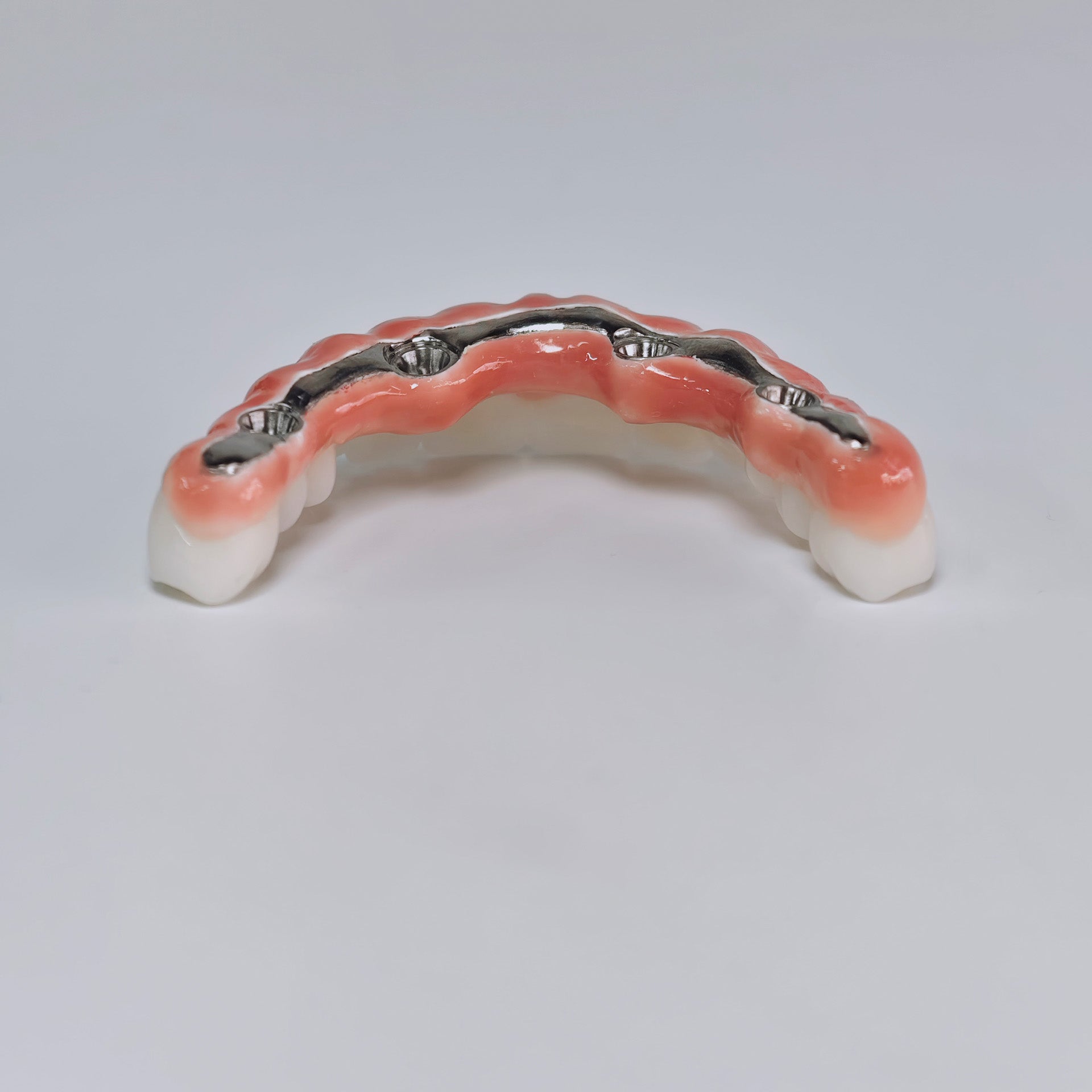 Zirconia-Enamel Hybrid Malo Bridge Aesthetic