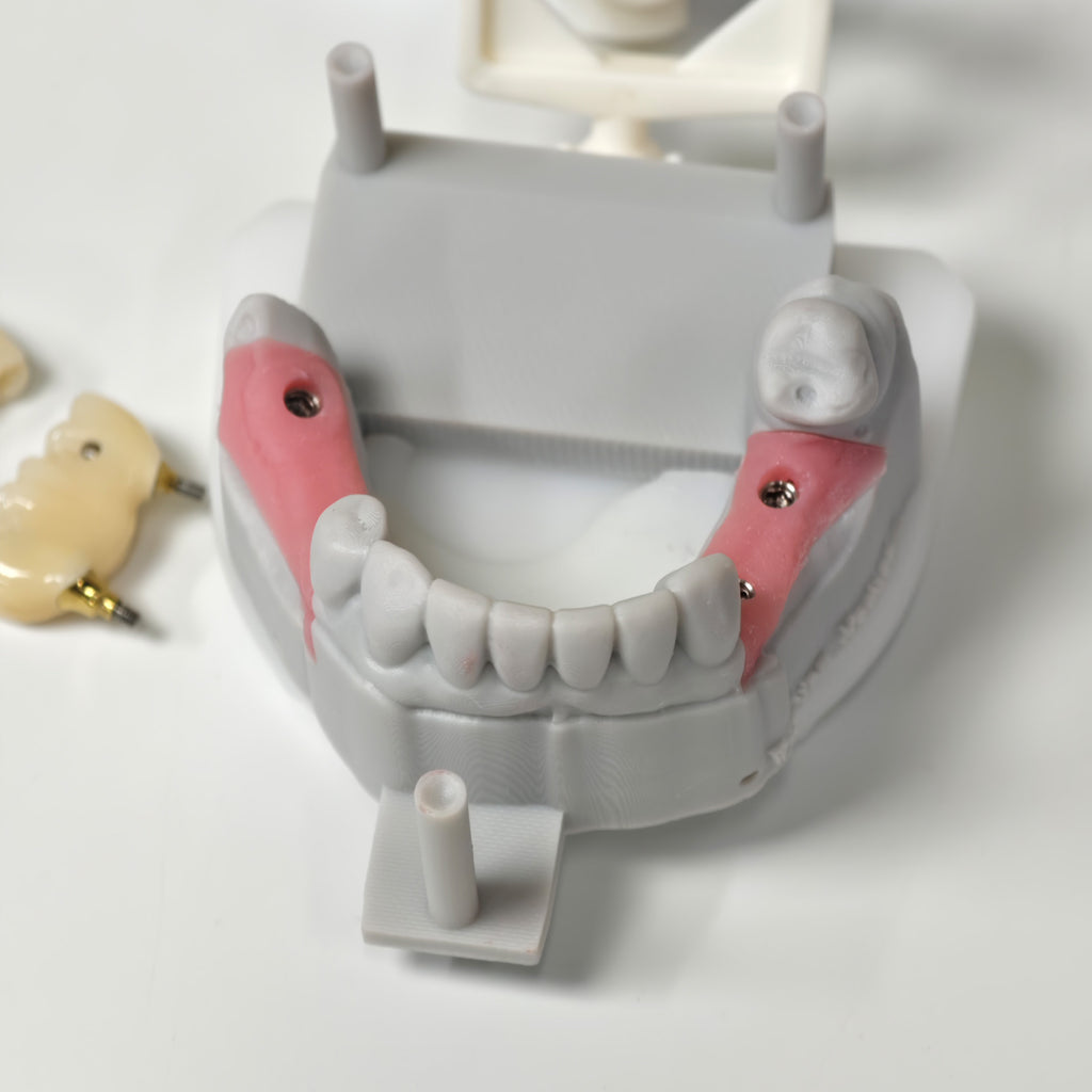 Zirconia Bridges With Screw Retained