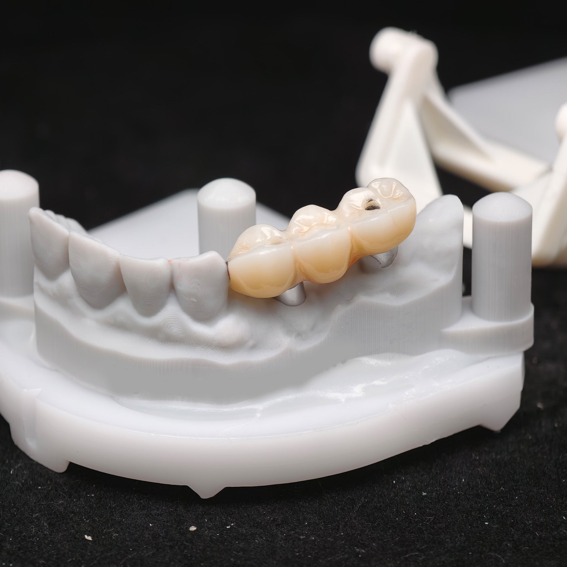 Zirconia Bridge With Ti-Base Screw Retained