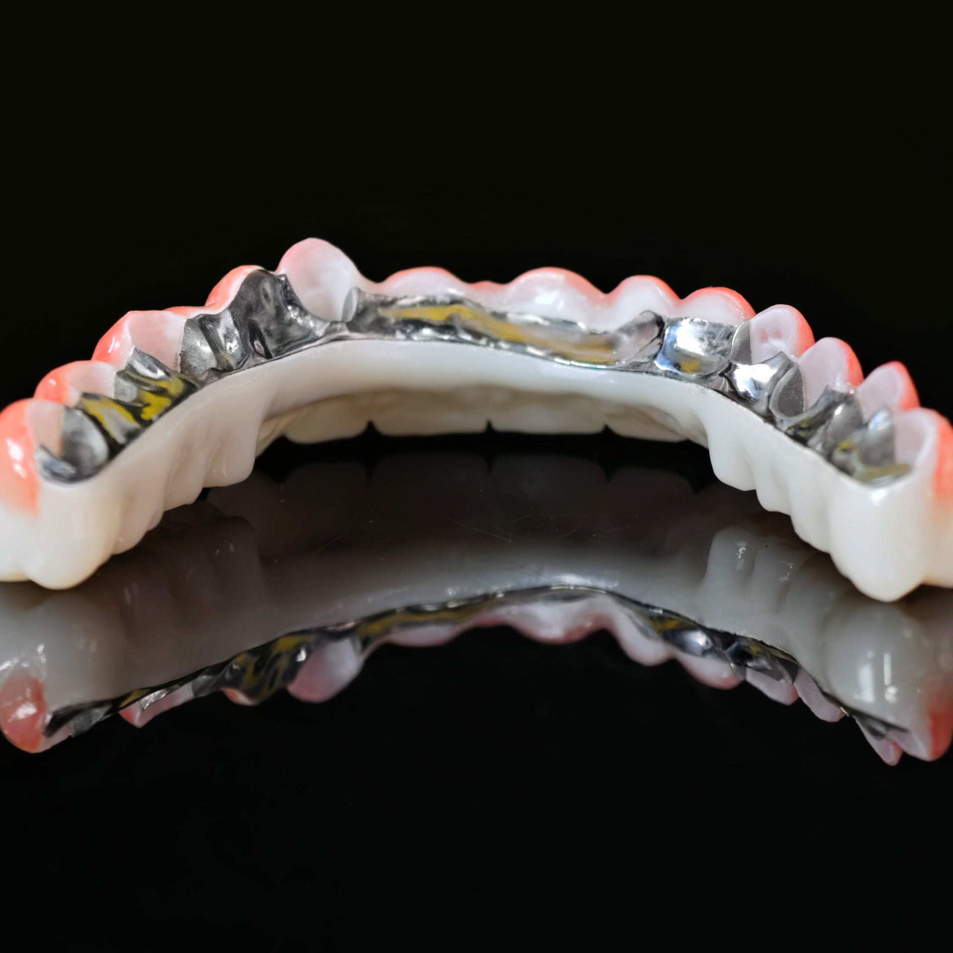 Zirconia Bridge With Cement Retained And Titanium Bar