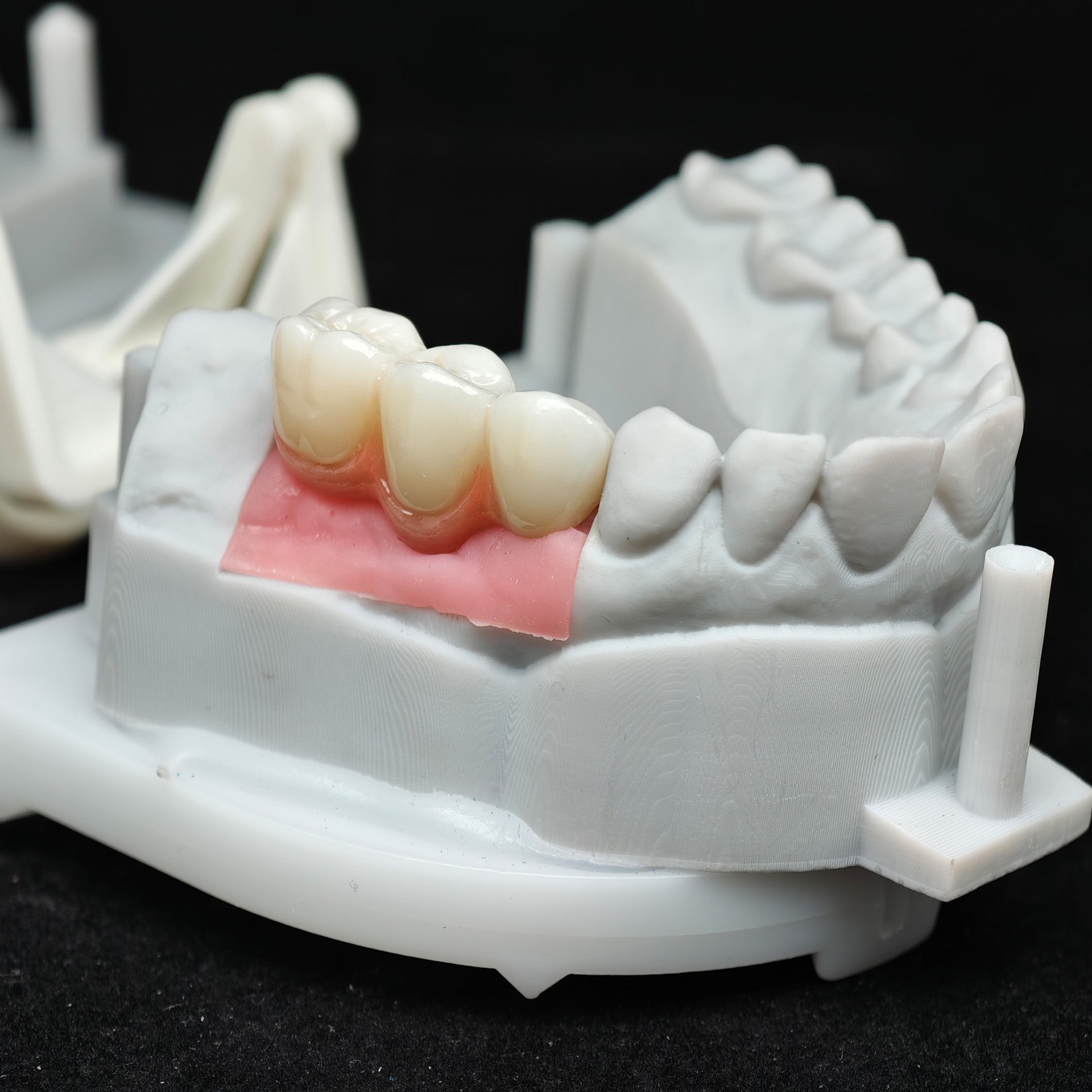 Zirconia Bridge With Screw Retained