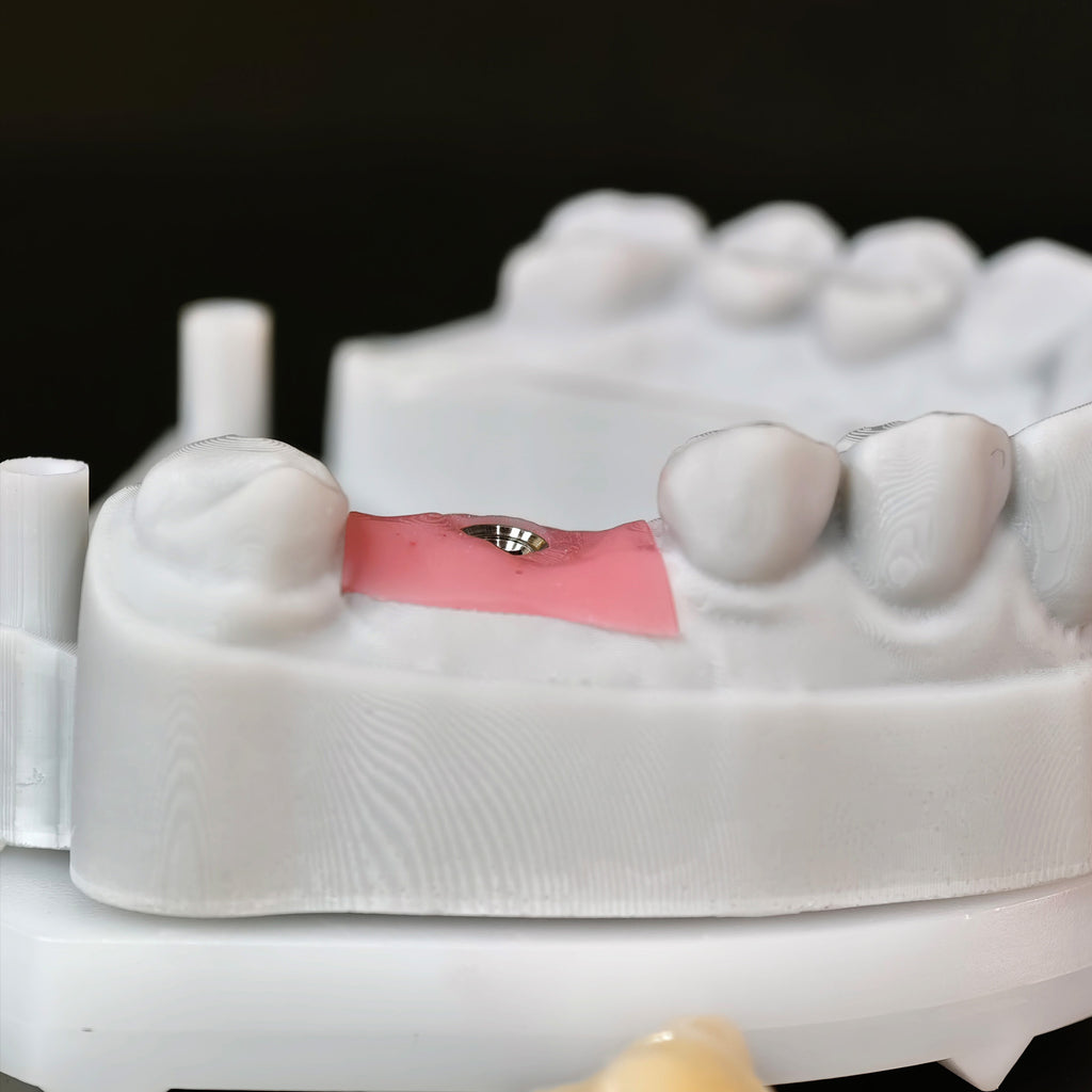 Zirconia Bridge With Screw Retained