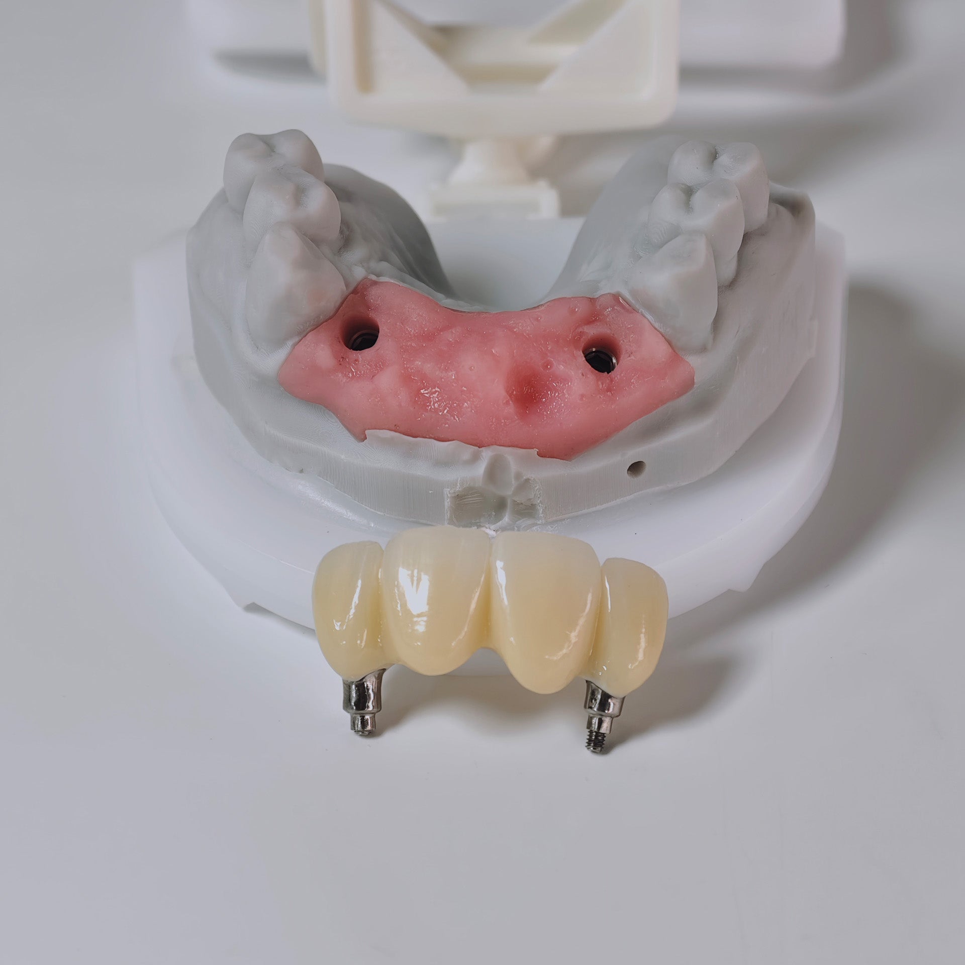 Zirconia Bridge With Screw Retained