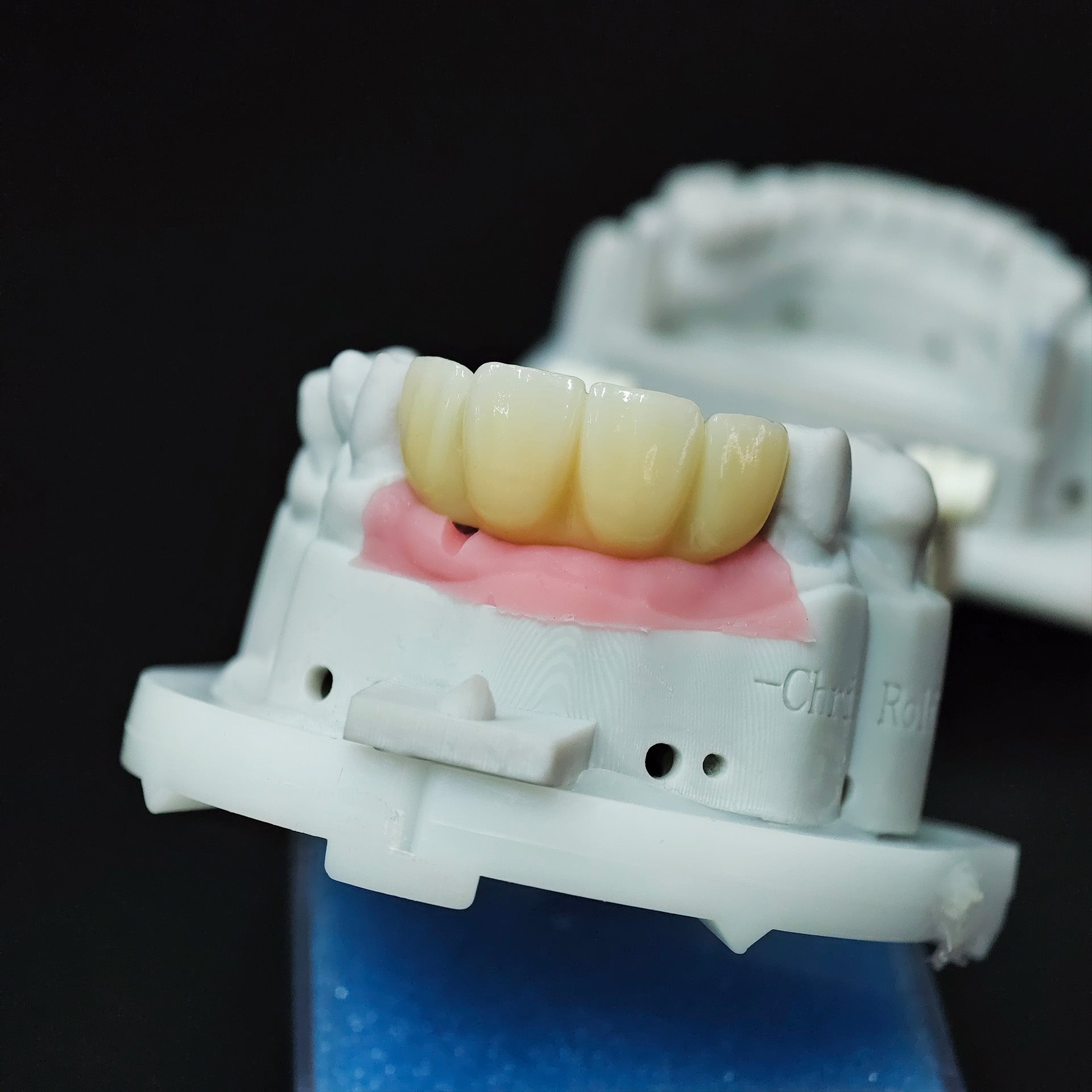 Zirconia Bridge With Screw Retained