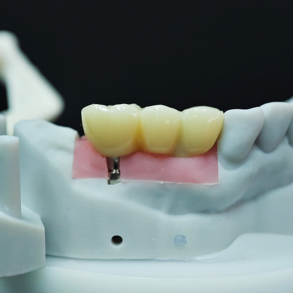Zirconia Bridge With Screw Retained