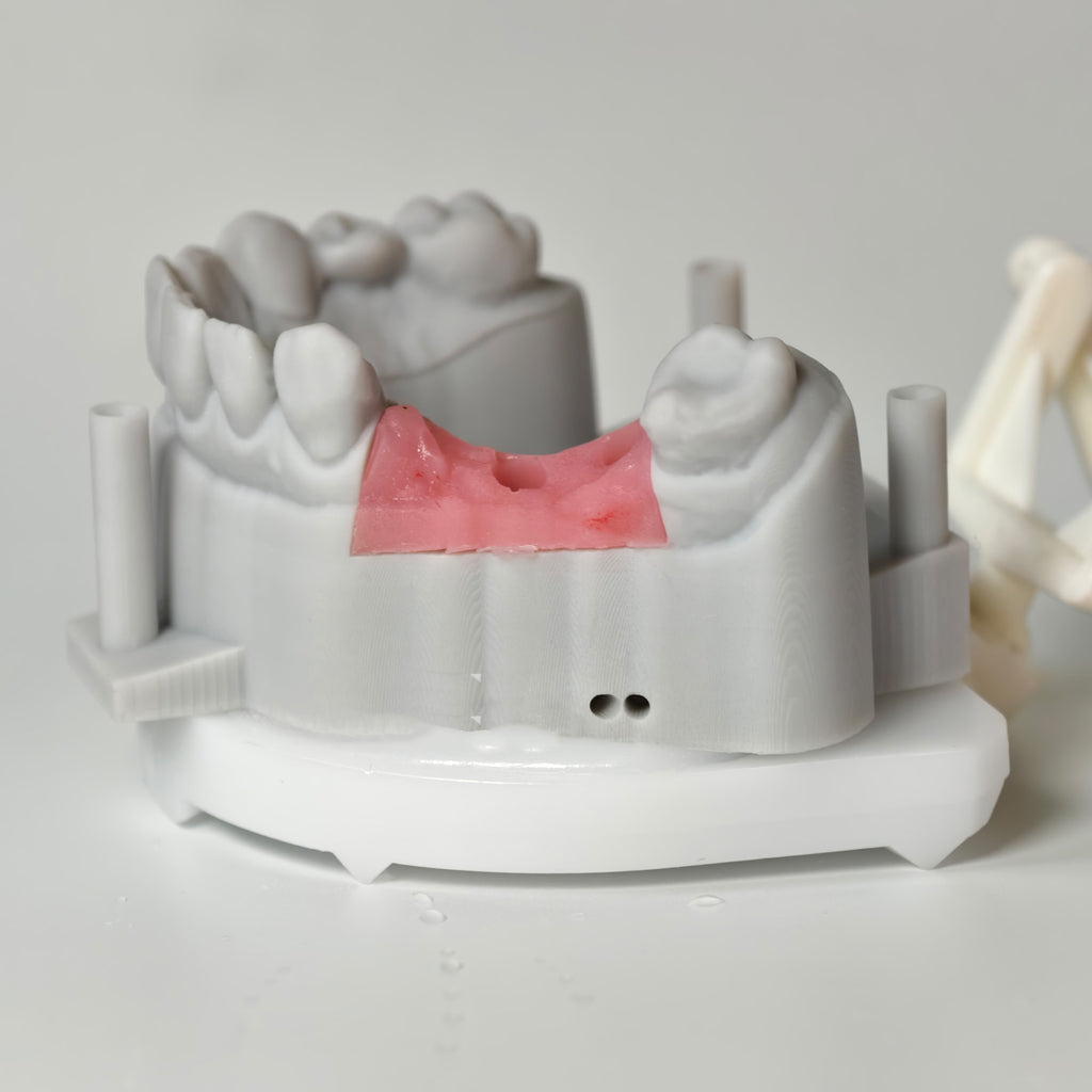 Zirconia Bridgewith Screw Retained