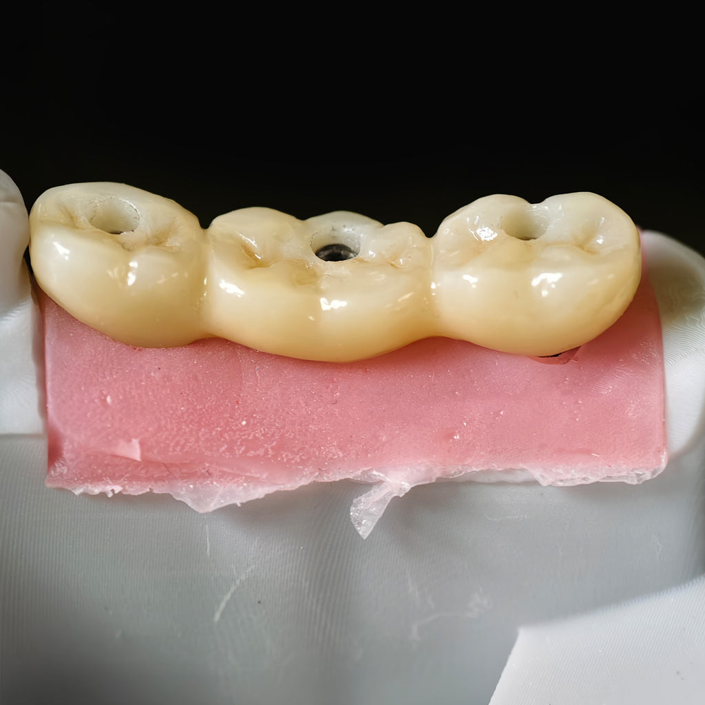Zirconia Bridge With Screw Retained Gold Plating