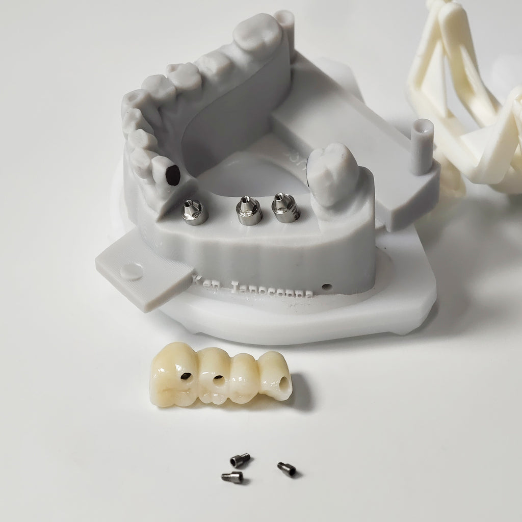 Zirconia Bridge With Ti-Base Screw Retained