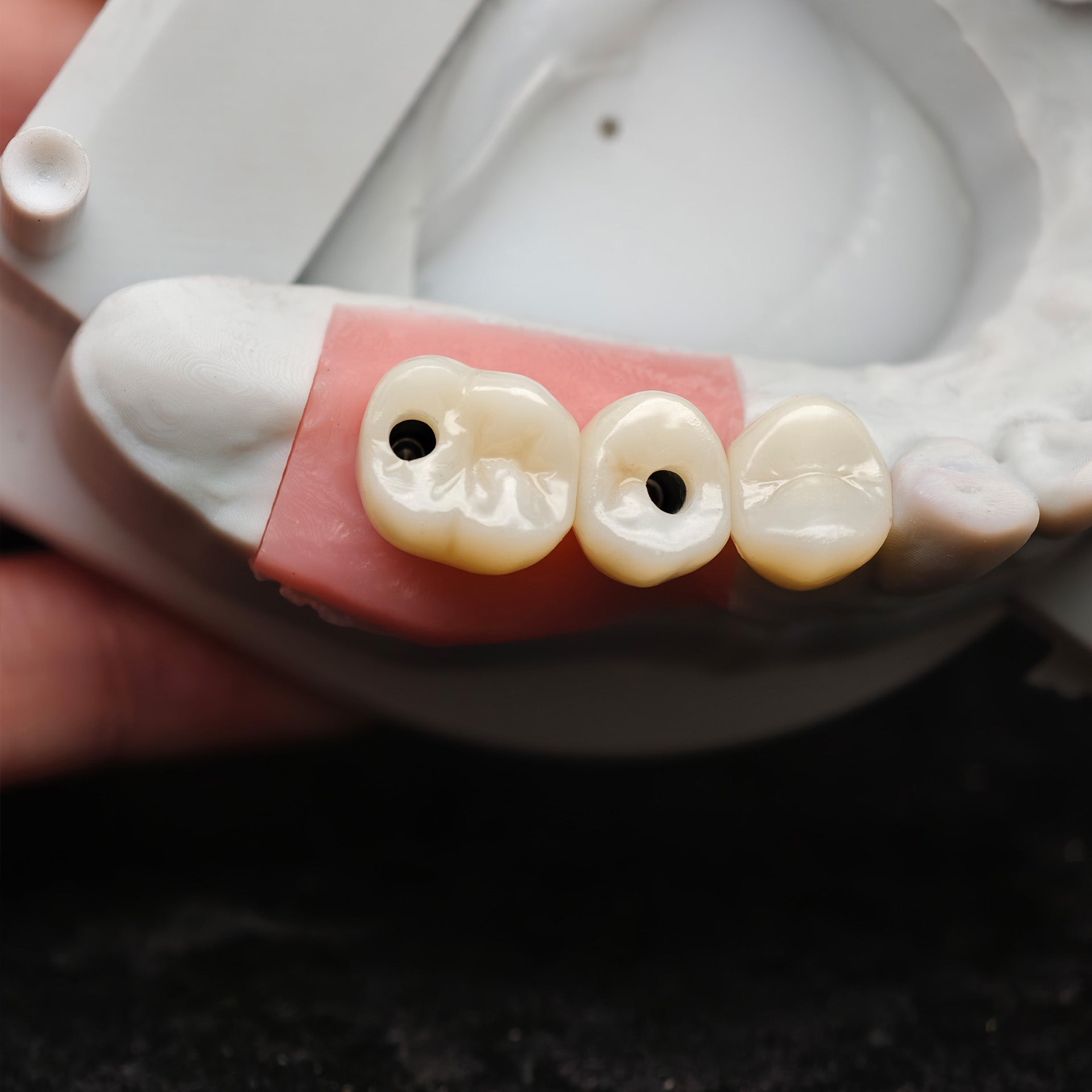 Zirconia Crown And Bridge With Screw Retained