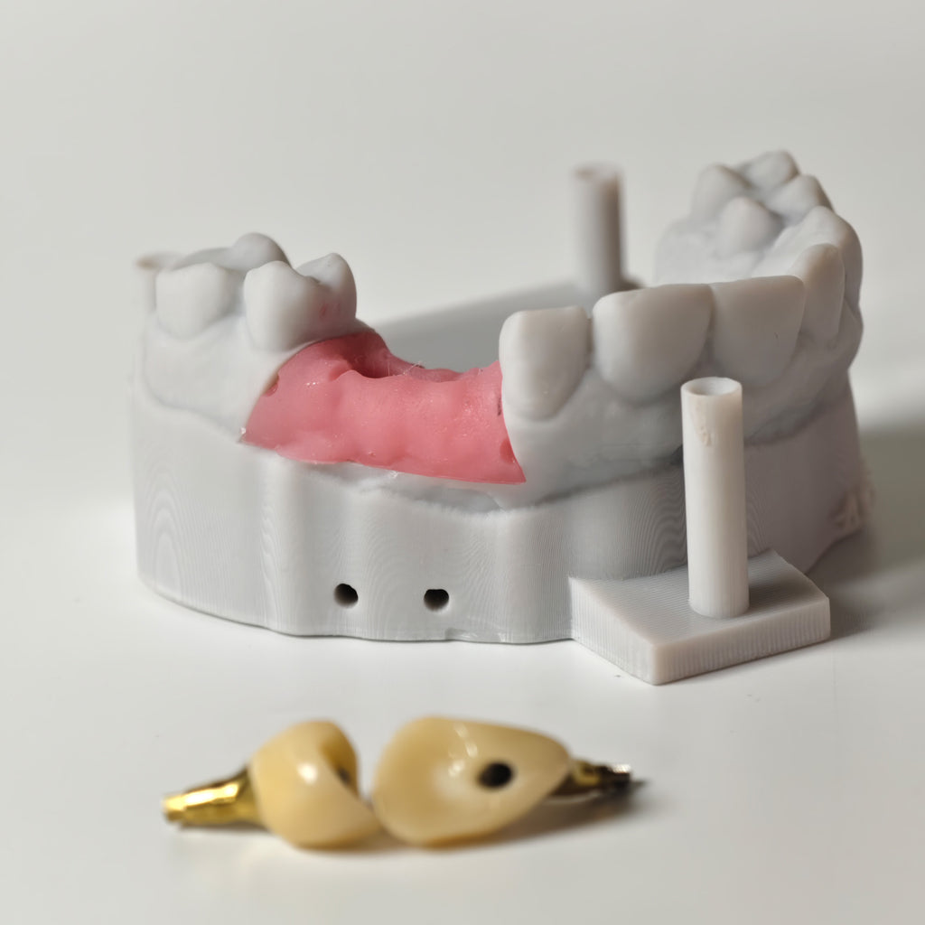 Zirconia Crowns With Gold-Plated Abutment