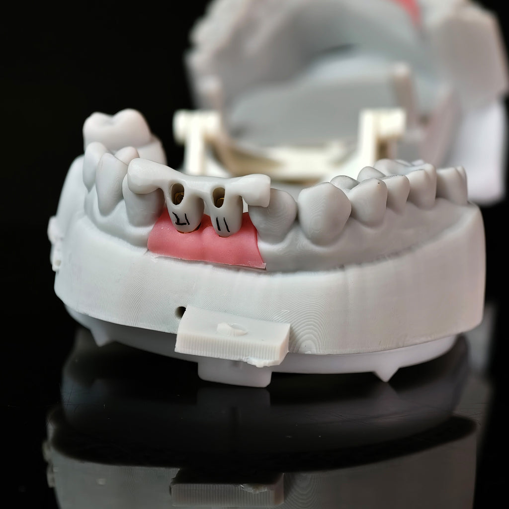 Zirconia Crowns With Gold-Plated Abutment And Implant Seating Guide
