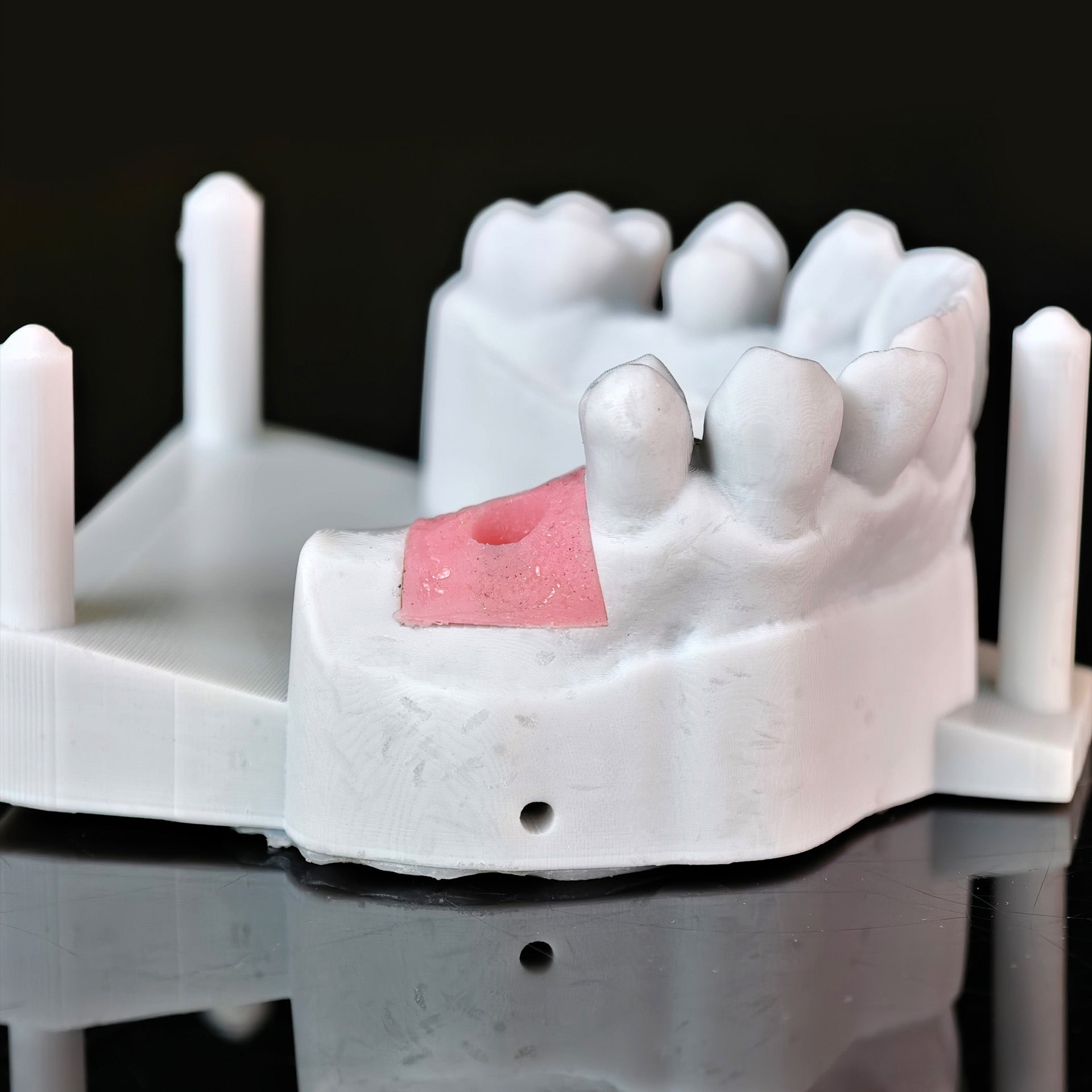 Zirconia Crowns With Screw Retained