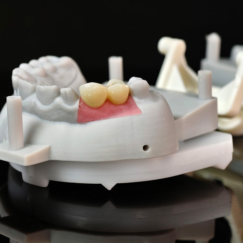 Zirconia Crowns With Screw Retained