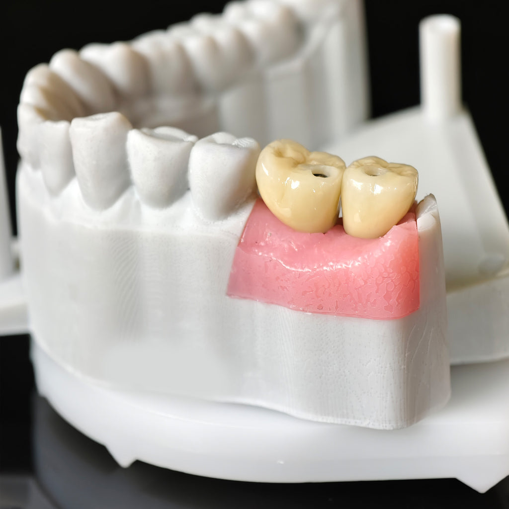 Zirconia Crowns With Screw Retained
