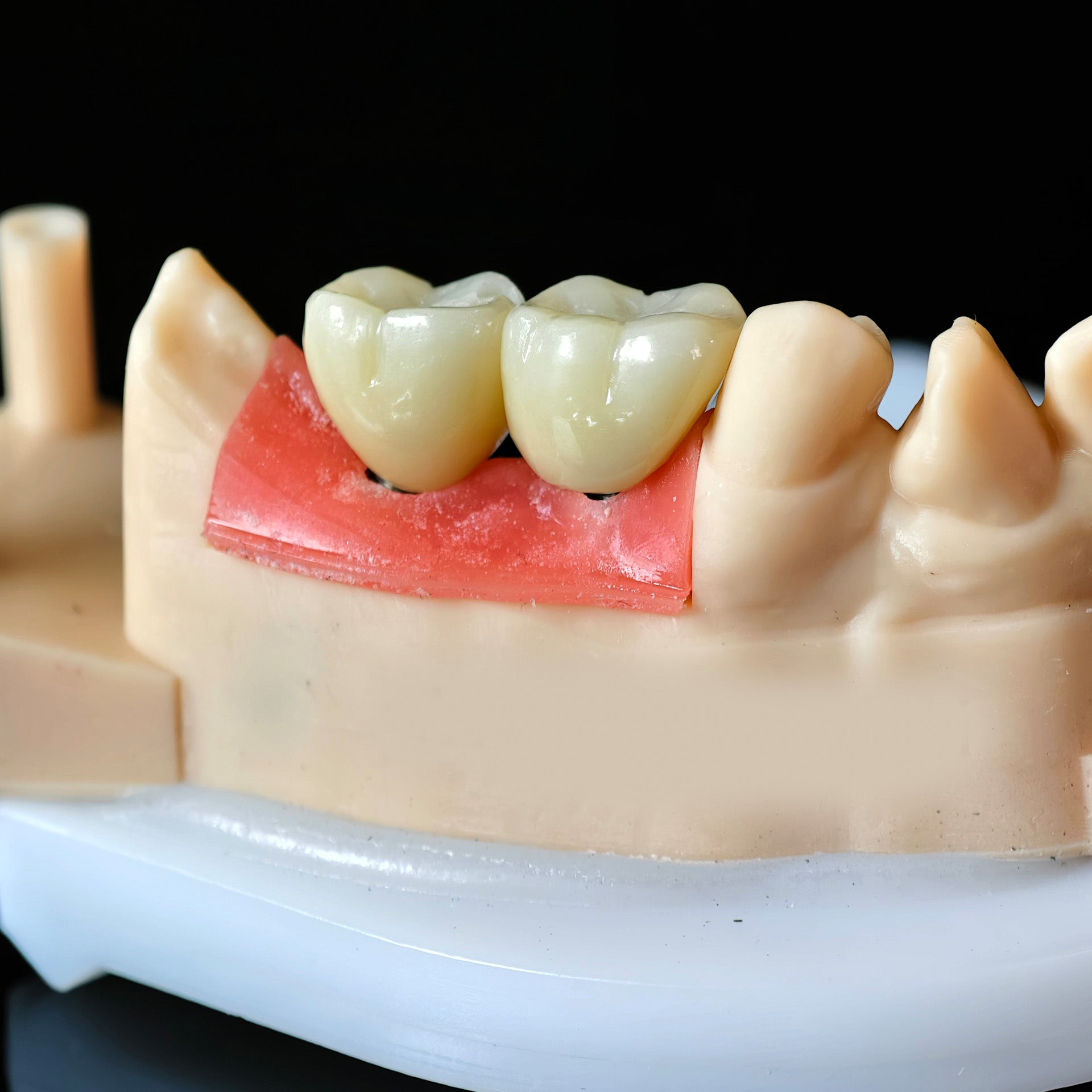 Zirconia Crowns With Screw Retained