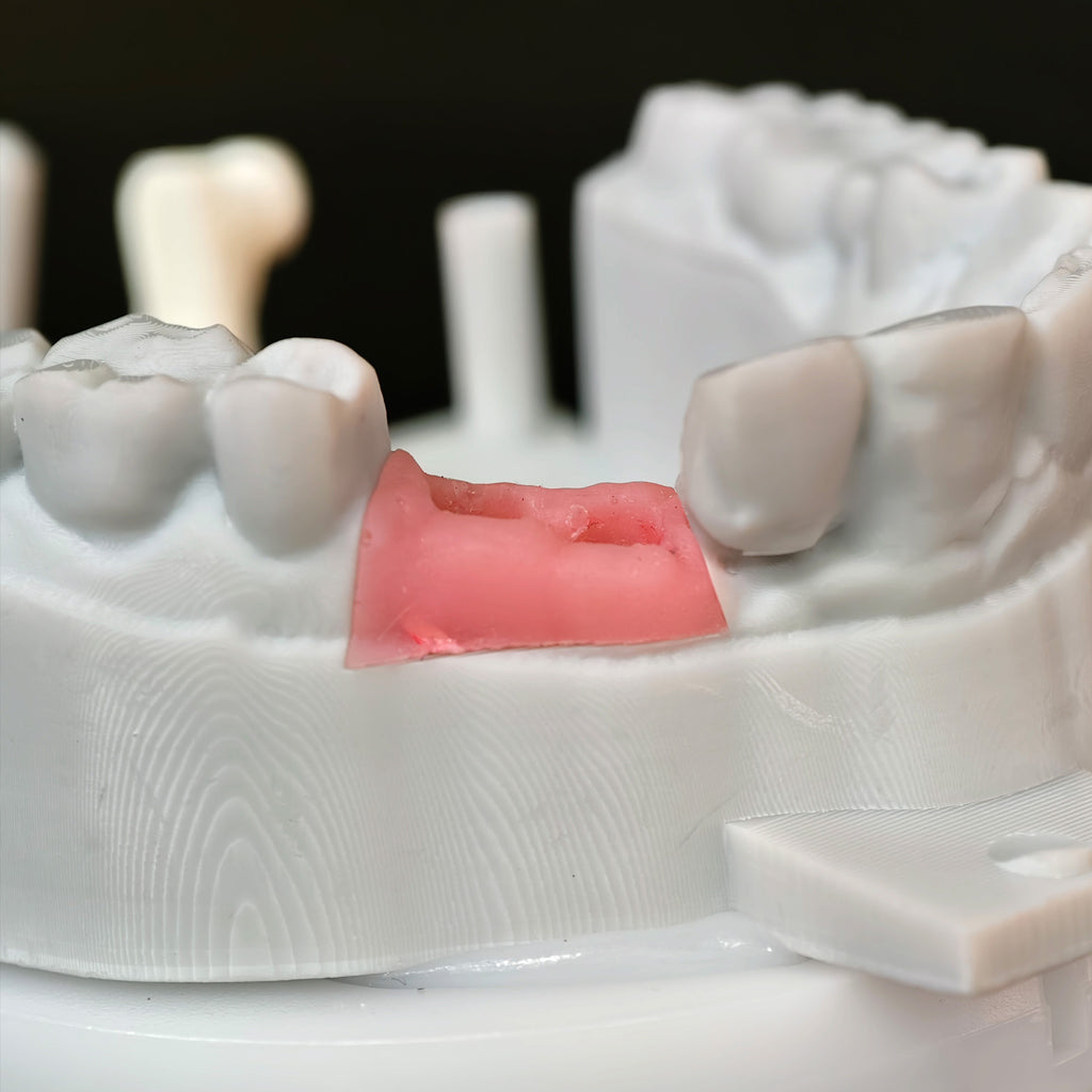 Zirconia Crowns With Screw Retained