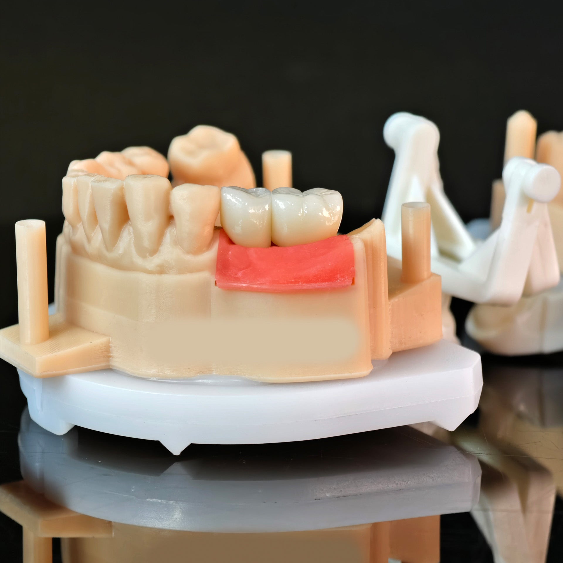 Zirconia Crowns With Screw Retained