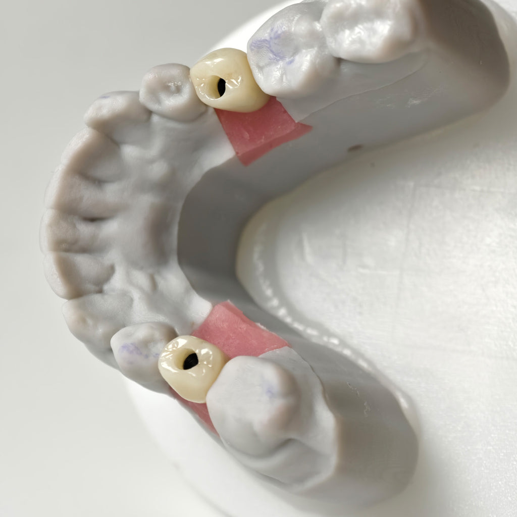 Zirconia Crowns With Screw Retained