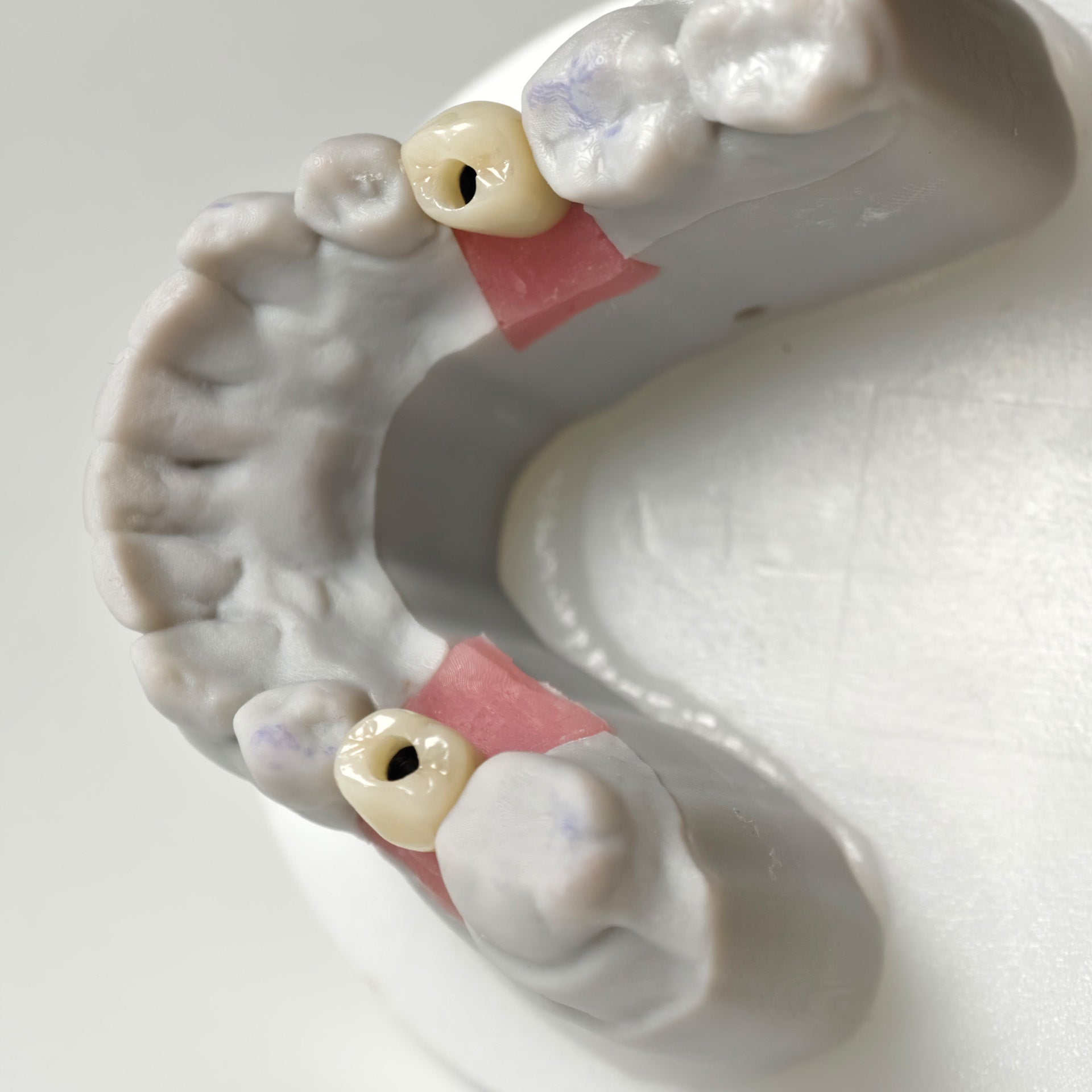 Zirconia Crowns With Screw Retained